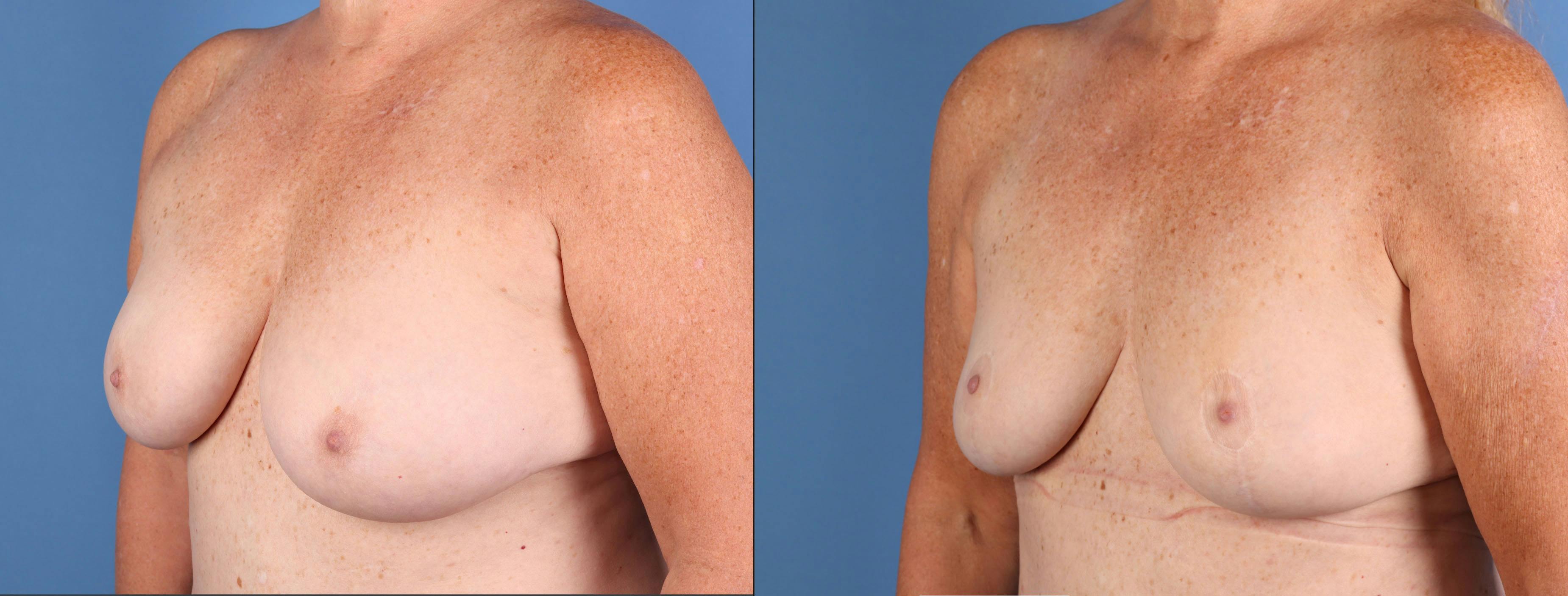 Breast Reduction Before & After Gallery - Patient 351749 - Image 2