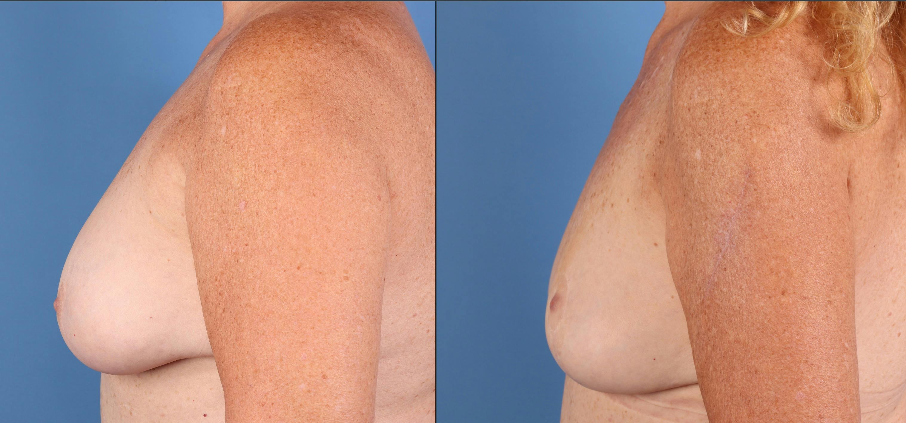 Breast Reduction Before & After Gallery - Patient 351749 - Image 3