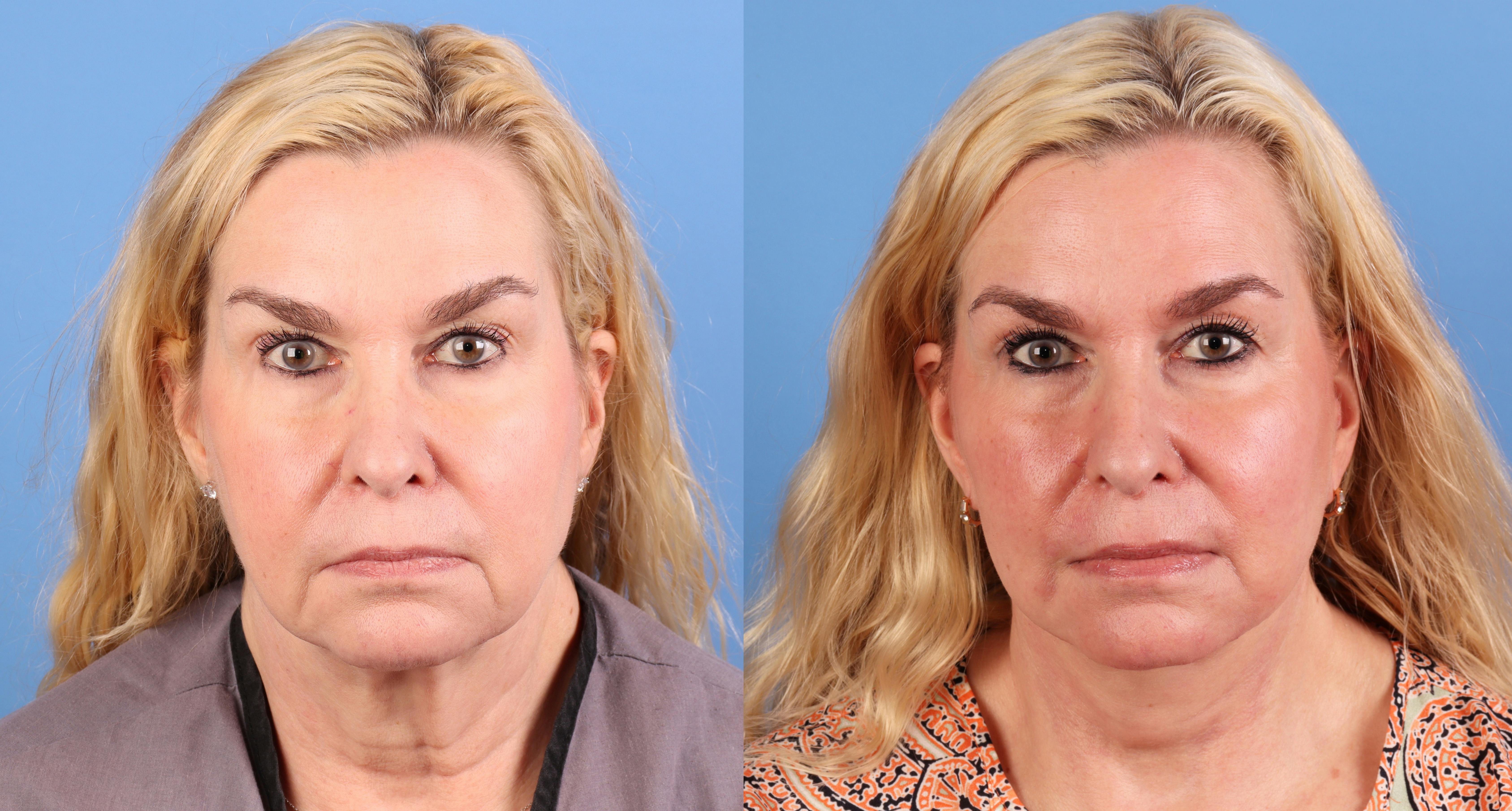 Face Lift Before & After Gallery - Patient 172212 - Image 1