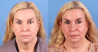 Face Lift Before & After Gallery - Patient 172212 - Image 1