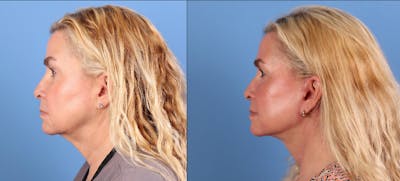 Neck Lift Before & After Gallery - Patient 384546 - Image 1