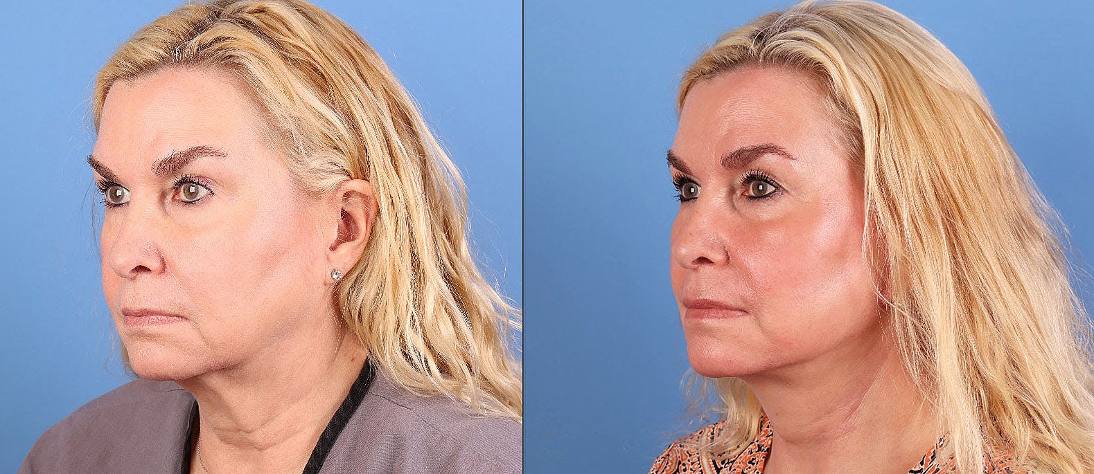 Face Lift Before & After Gallery - Patient 172212 - Image 3