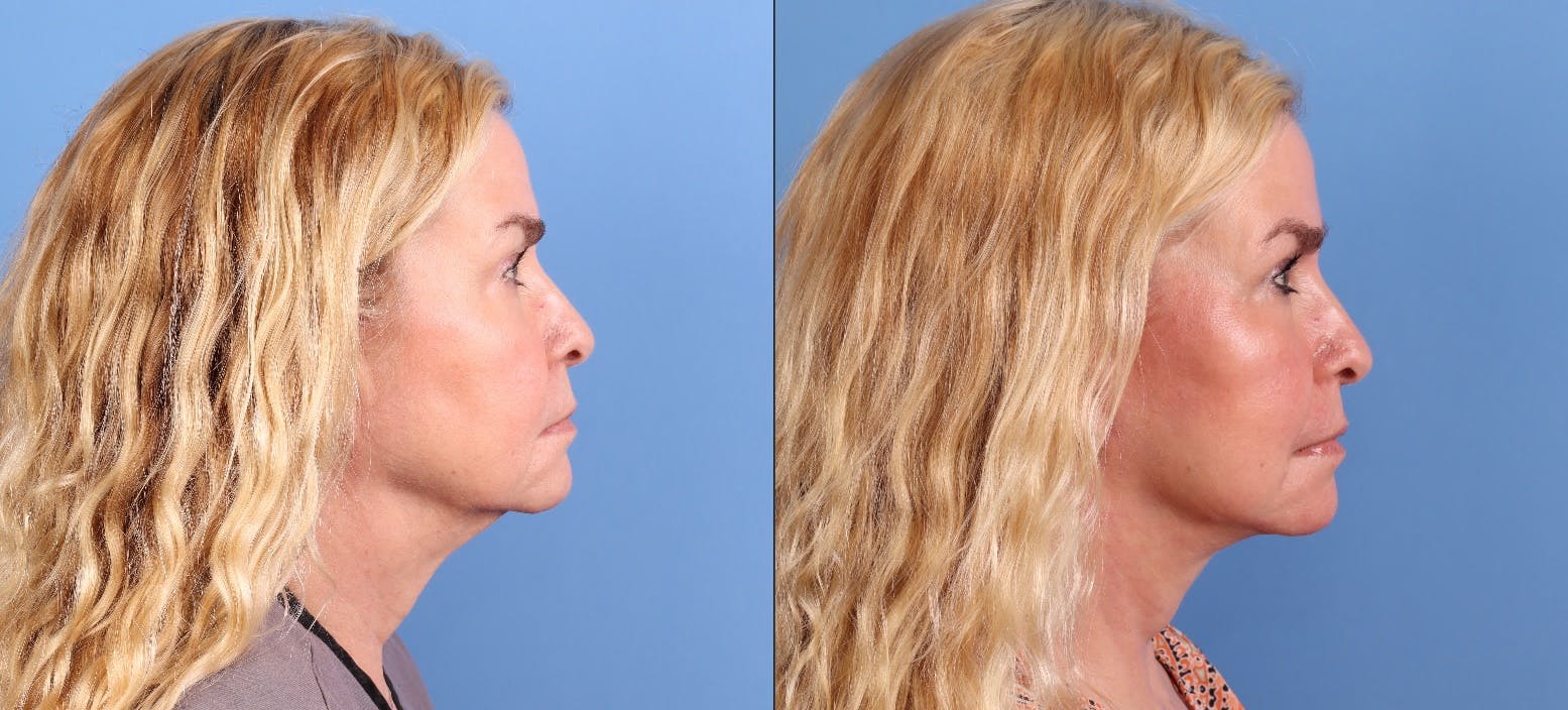 Face Lift Before & After Gallery - Patient 172212 - Image 5