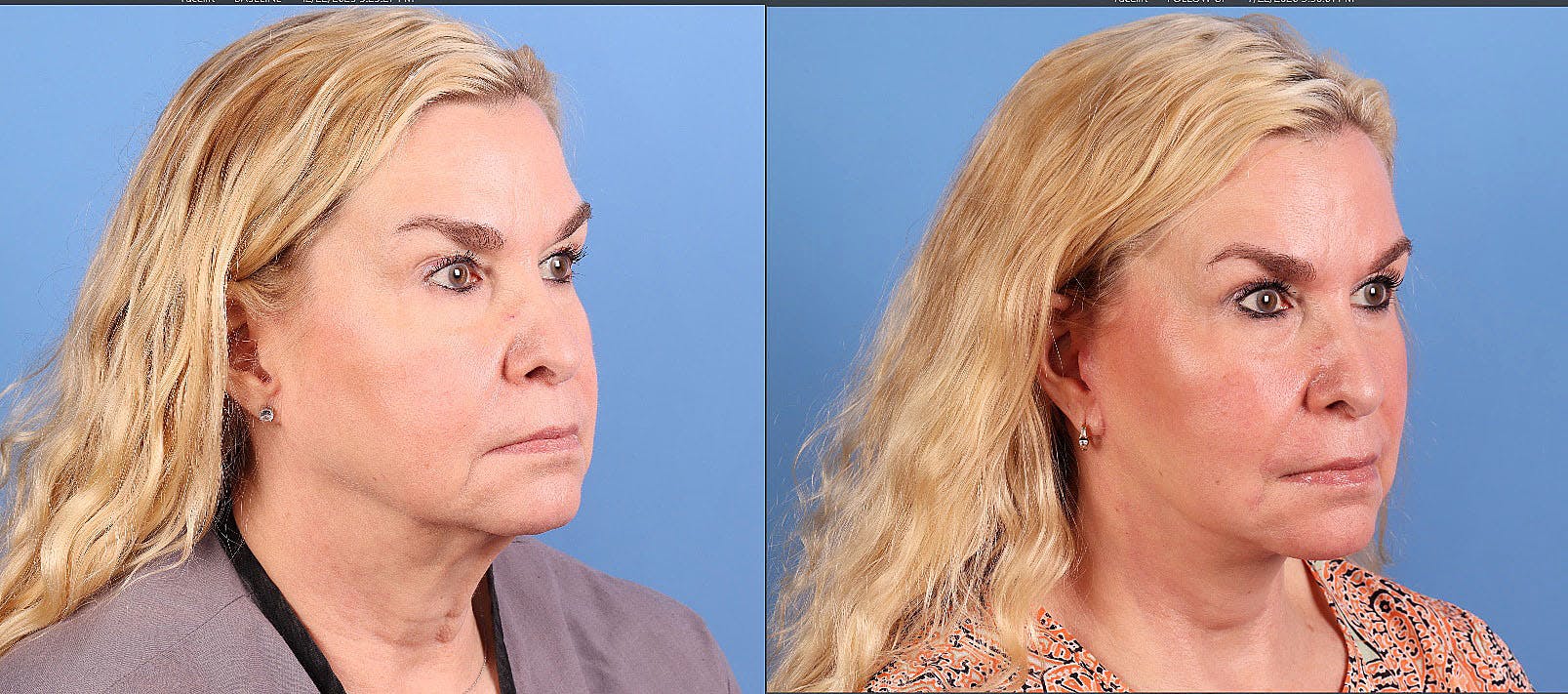 Face Lift Before & After Gallery - Patient 172212 - Image 2