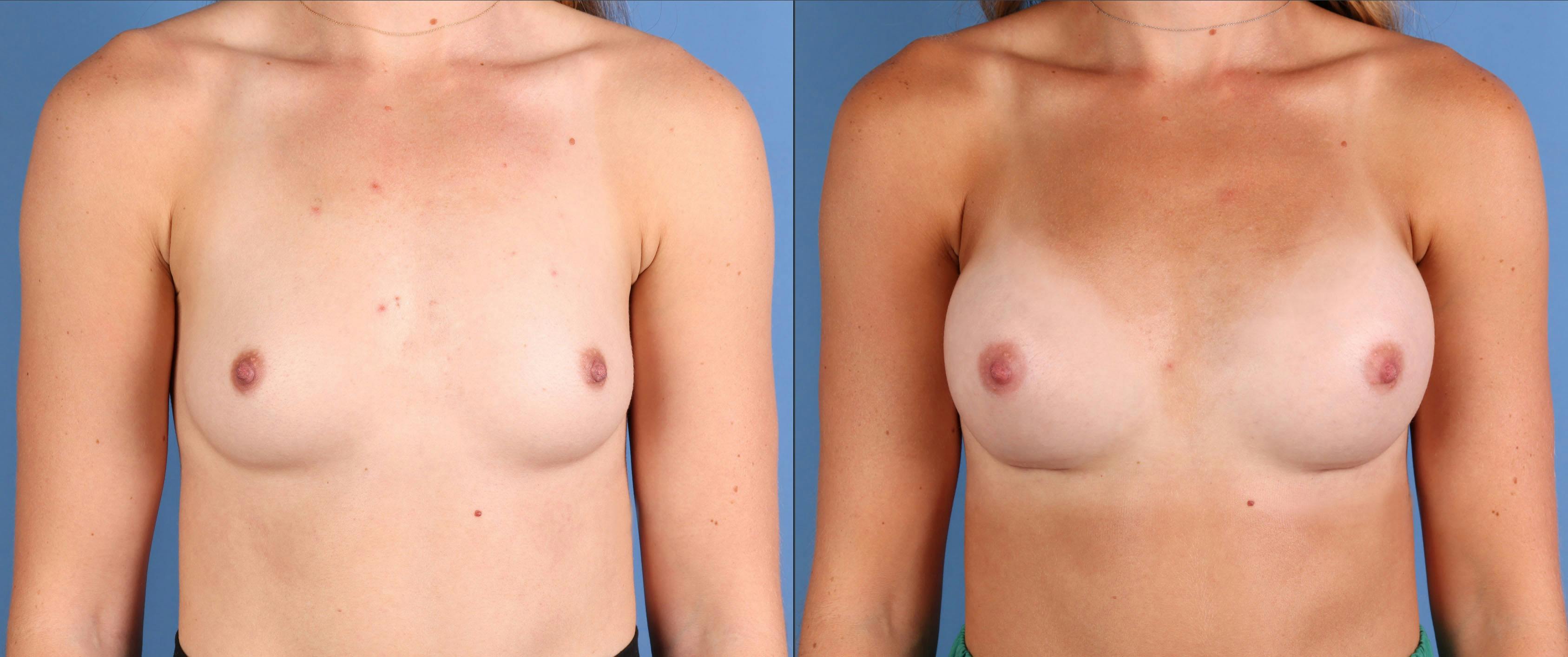 Breast Augmentation Before & After Gallery - Patient 103053 - Image 1