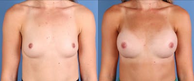 Breast Augmentation Before & After Gallery - Patient 103053 - Image 1