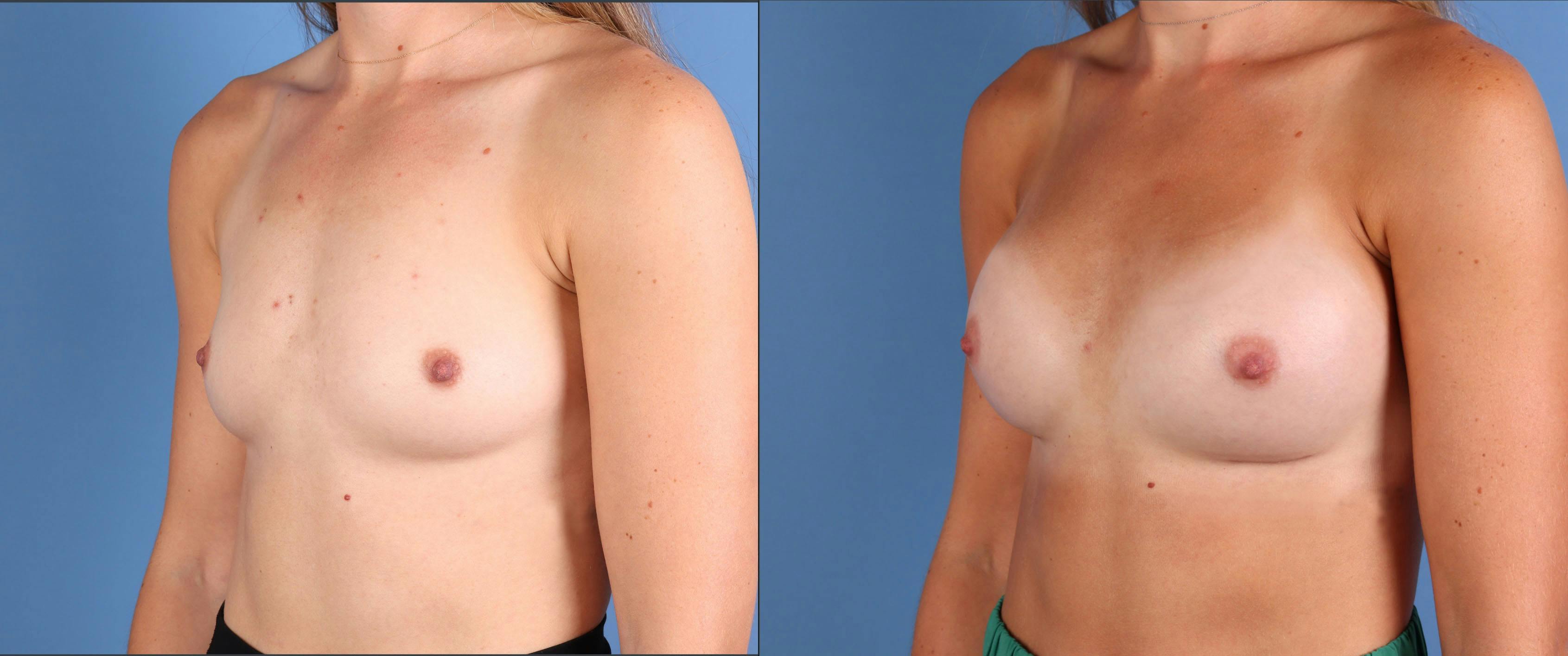 Breast Augmentation Before & After Gallery - Patient 103053 - Image 4