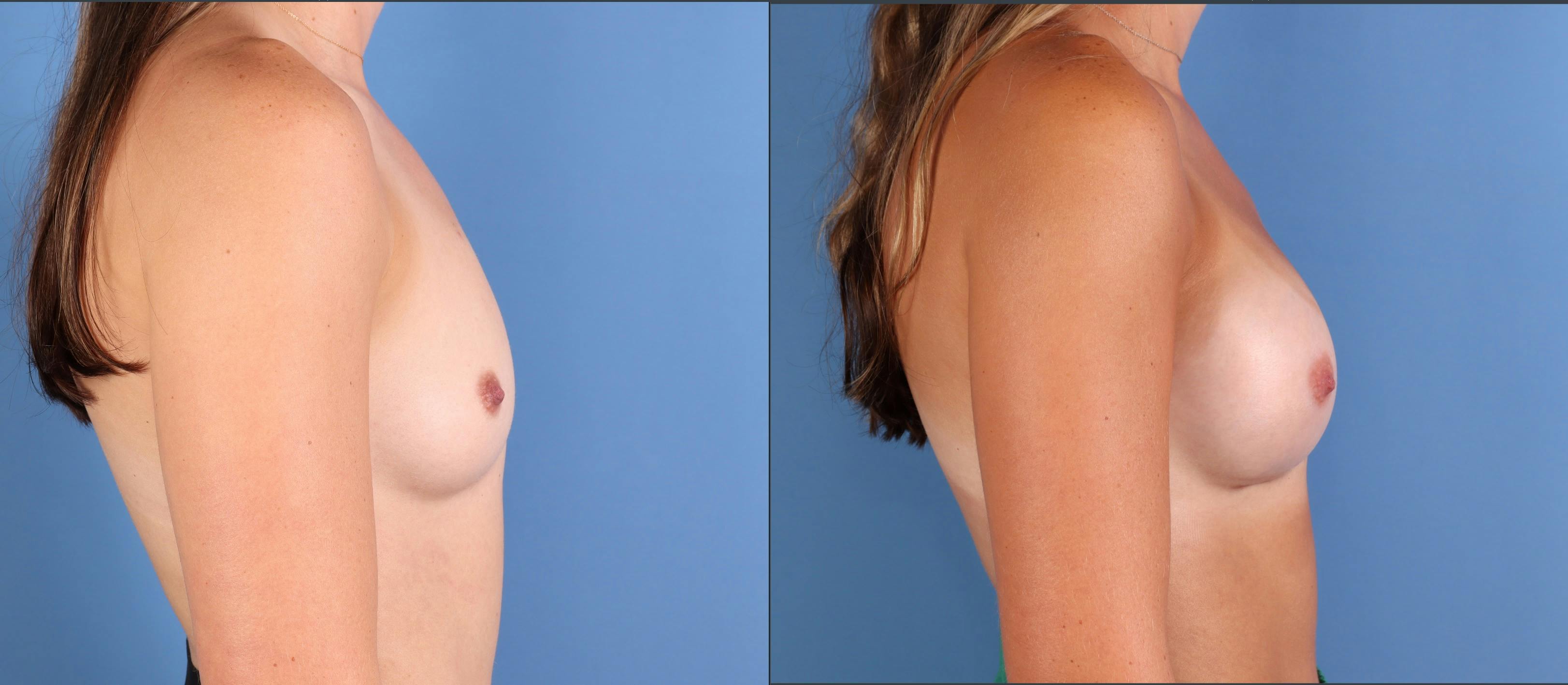 Breast Augmentation Before & After Gallery - Patient 103053 - Image 3