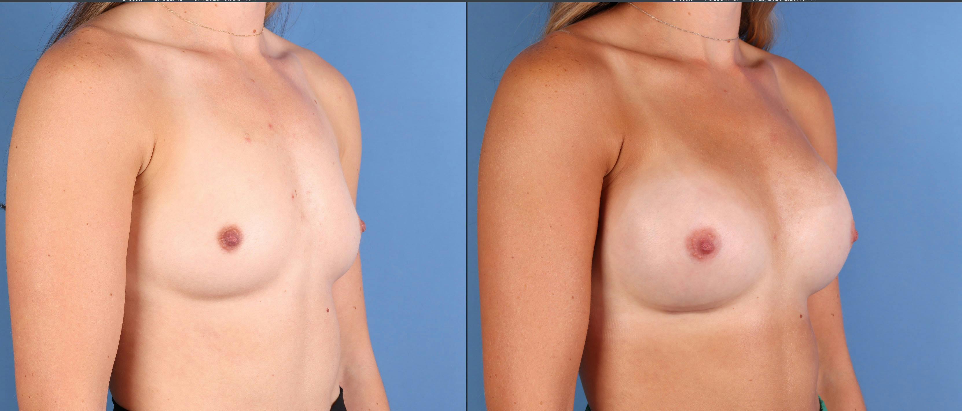 Breast Augmentation Before & After Gallery - Patient 103053 - Image 2