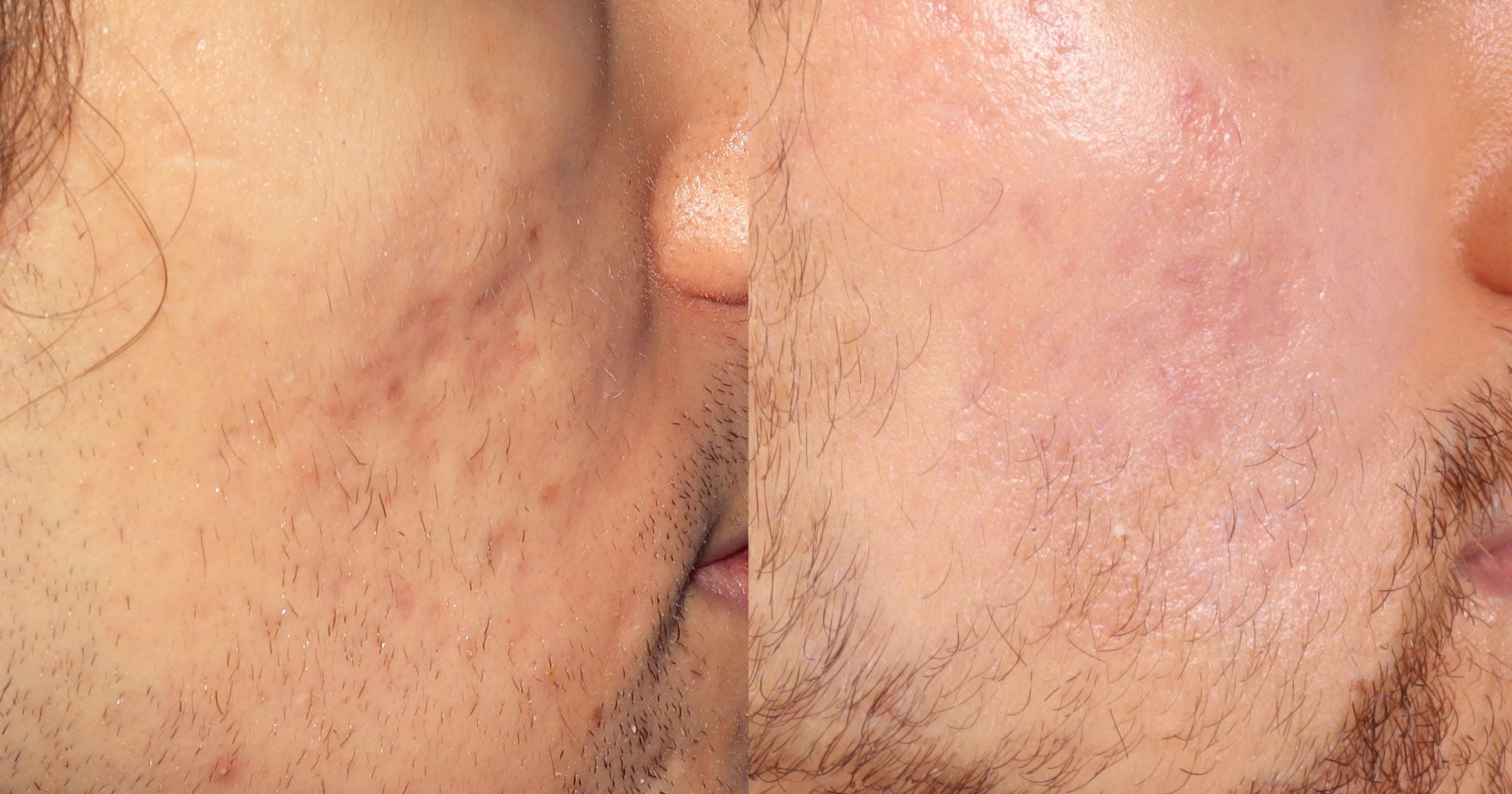 Scar Revision Before & After Gallery - Patient 130465 - Image 1