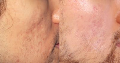 Scar Revision Before & After Gallery - Patient 130465 - Image 1