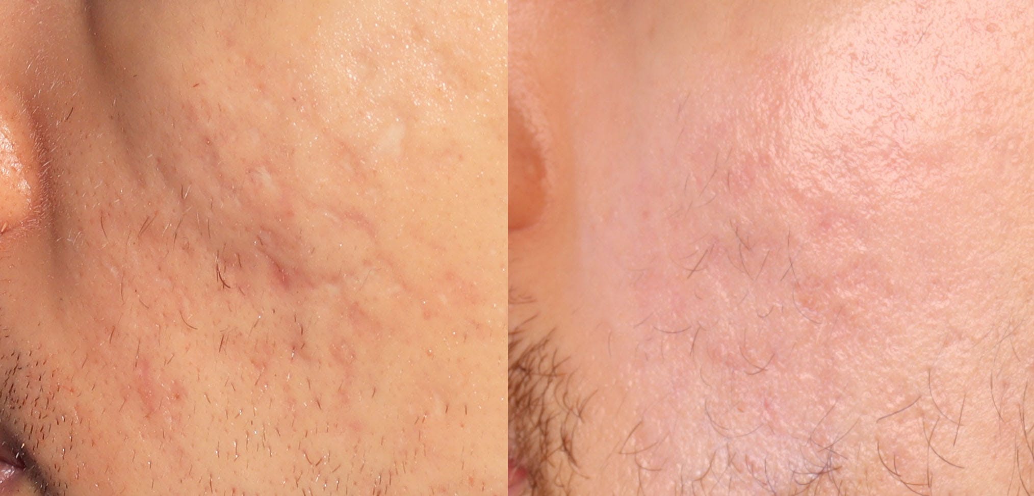 Scar Revision Before & After Gallery - Patient 130465 - Image 2