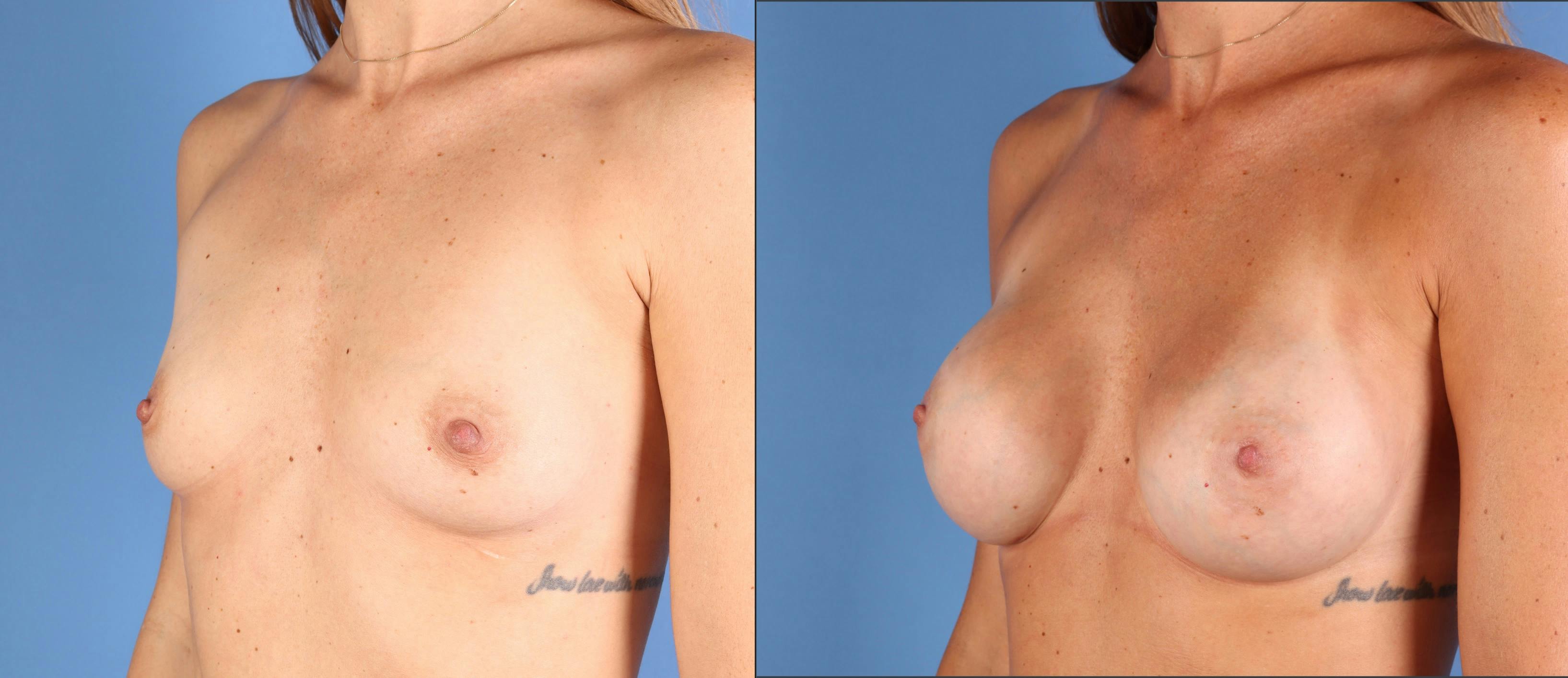 Breast Augmentation Before & After Gallery - Patient 363011 - Image 2