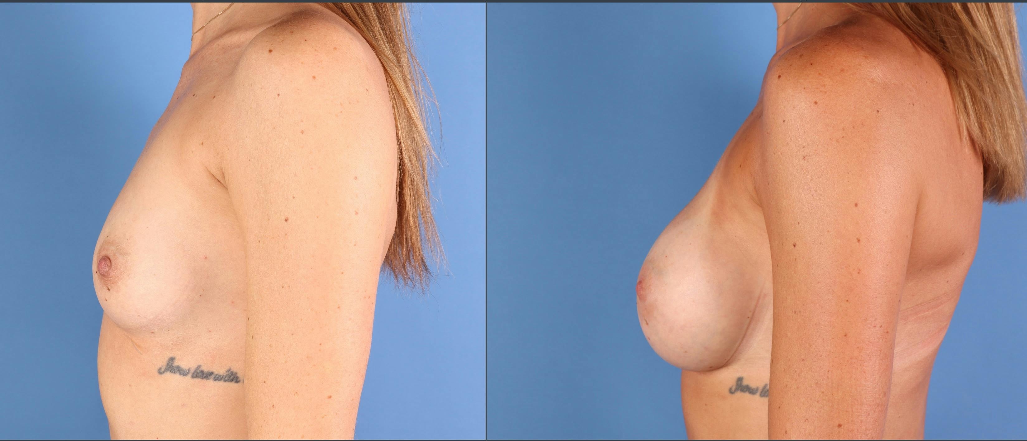 Breast Augmentation Before & After Gallery - Patient 363011 - Image 3