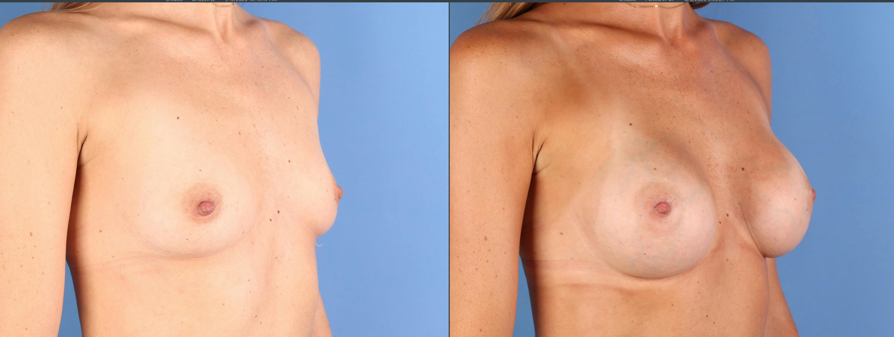 Breast Augmentation Before & After Gallery - Patient 363011 - Image 4