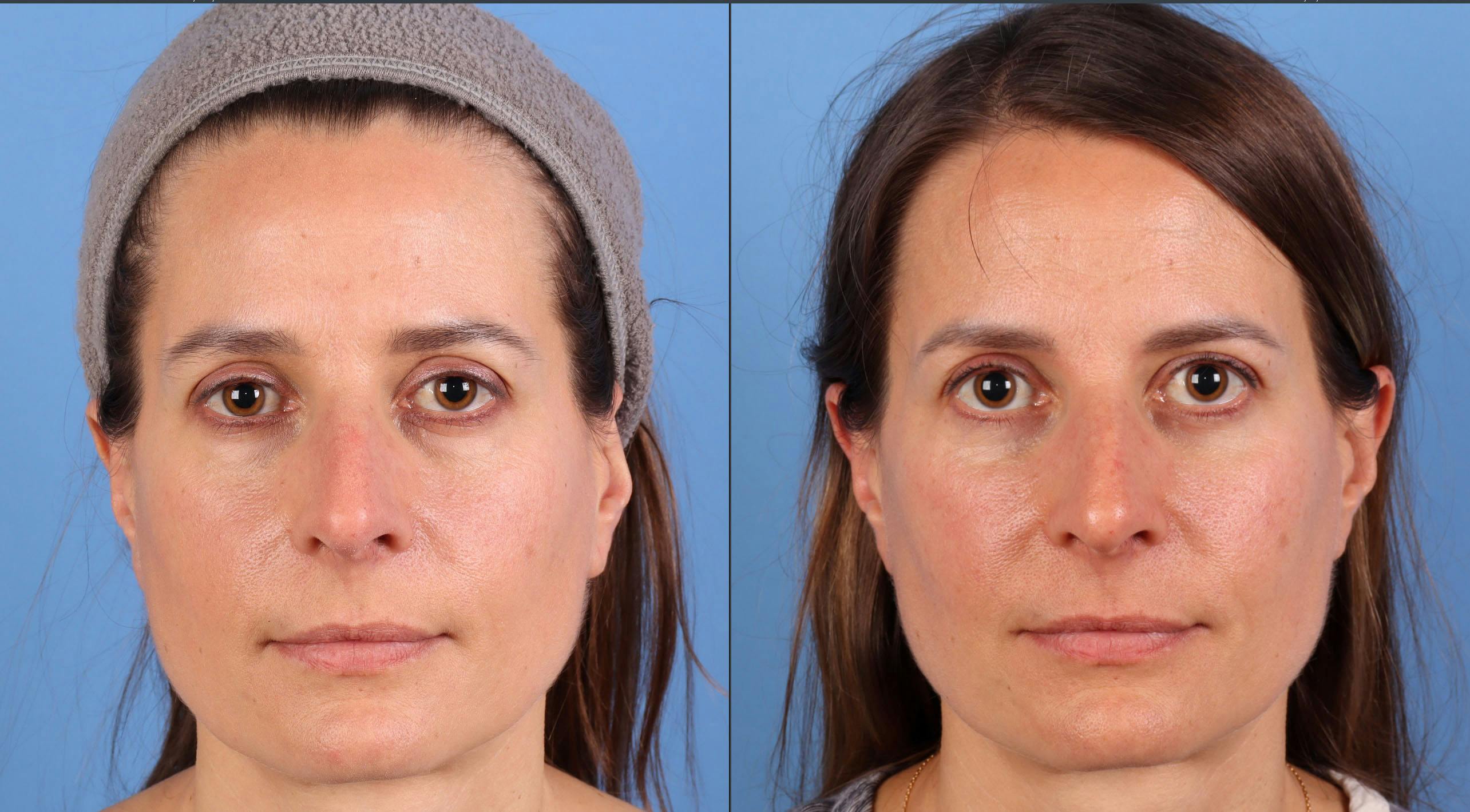 Eyelid Surgery (Upper & Lower Blepharoplasty) Before & After Gallery - Patient 403127 - Image 1