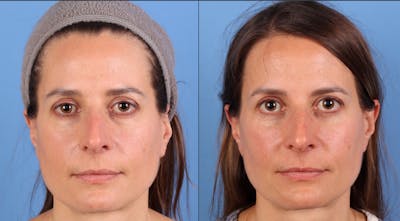 Eyelid Surgery (Upper & Lower Blepharoplasty) Before & After Gallery - Patient 403127 - Image 1