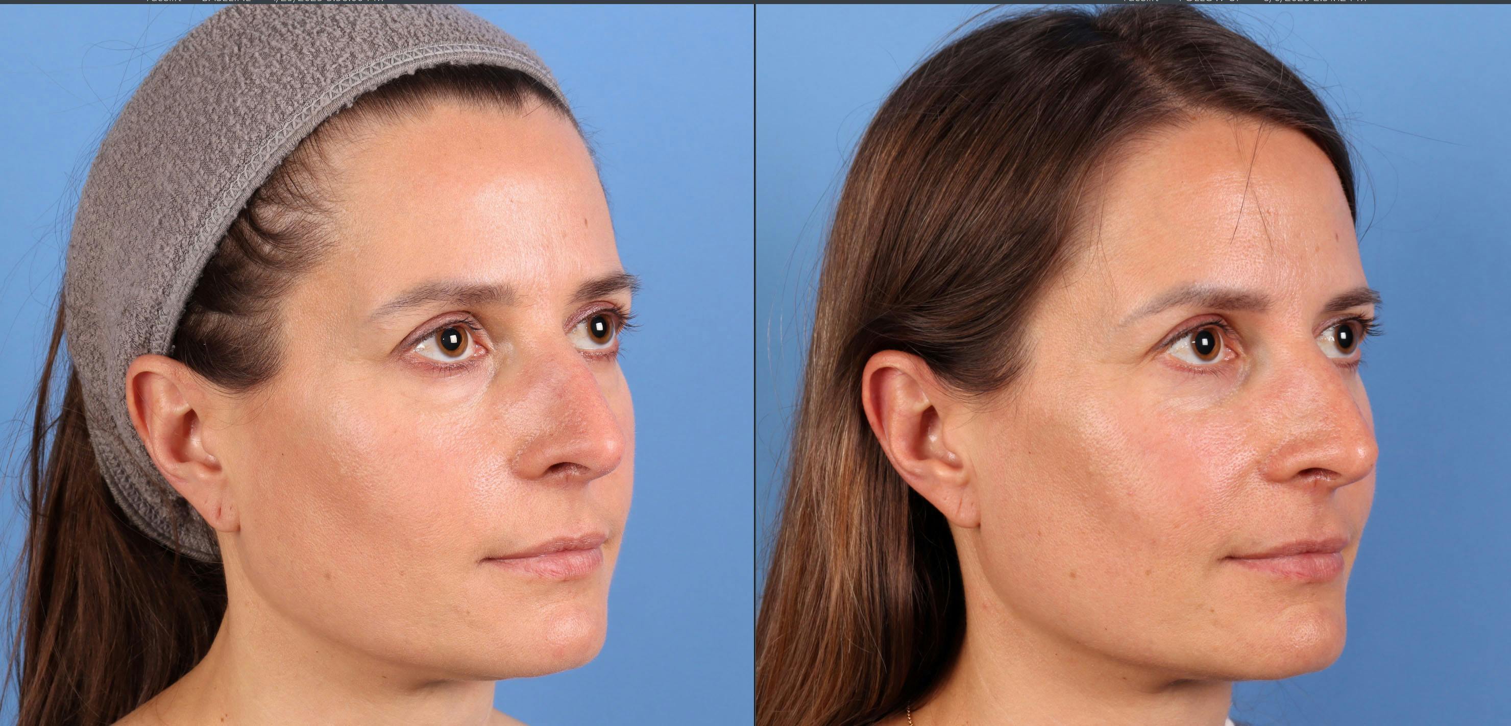 Eyelid Surgery (Upper & Lower Blepharoplasty) Before & After Gallery - Patient 403127 - Image 3