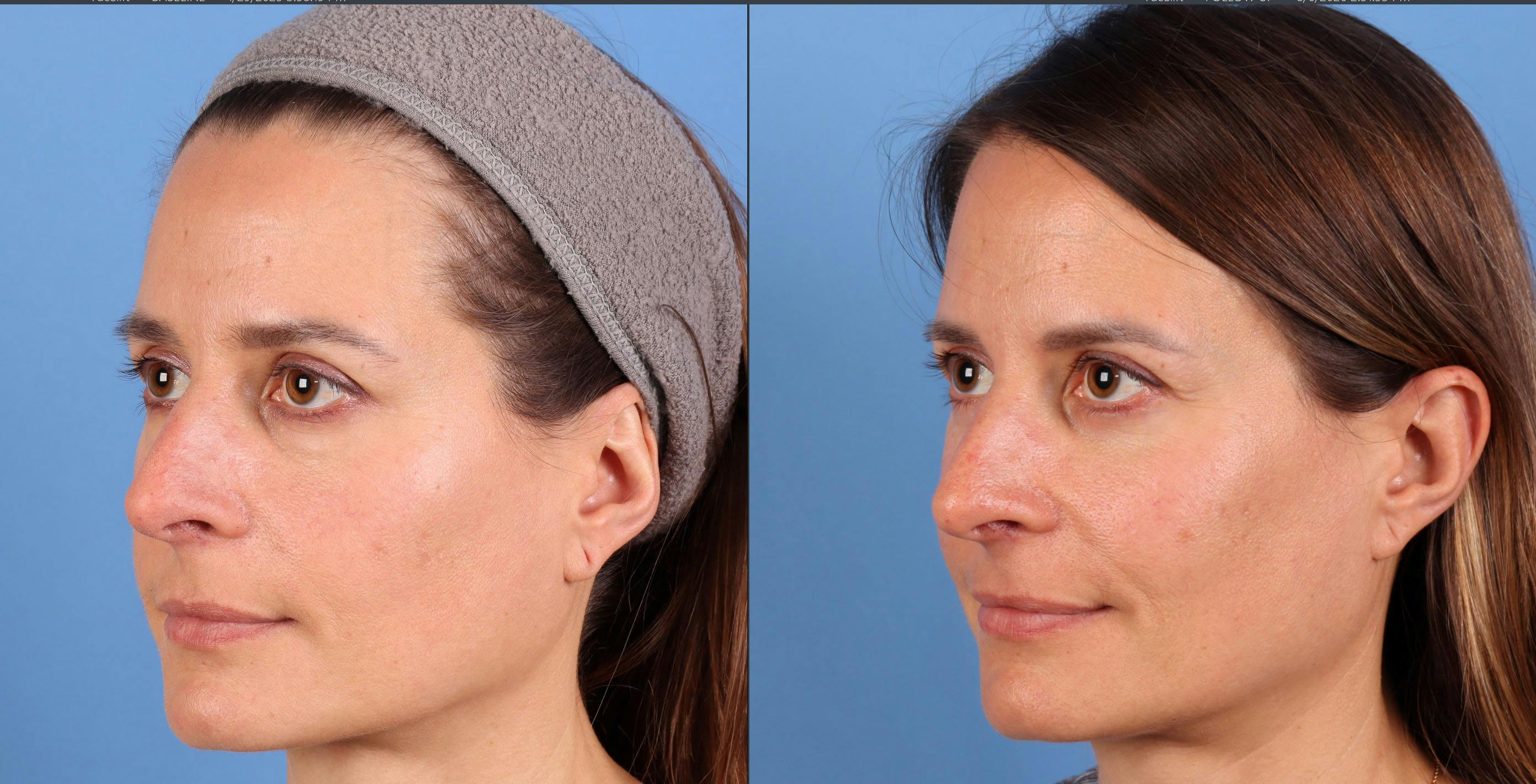 Eyelid Surgery (Upper & Lower Blepharoplasty) Before & After Gallery - Patient 403127 - Image 2