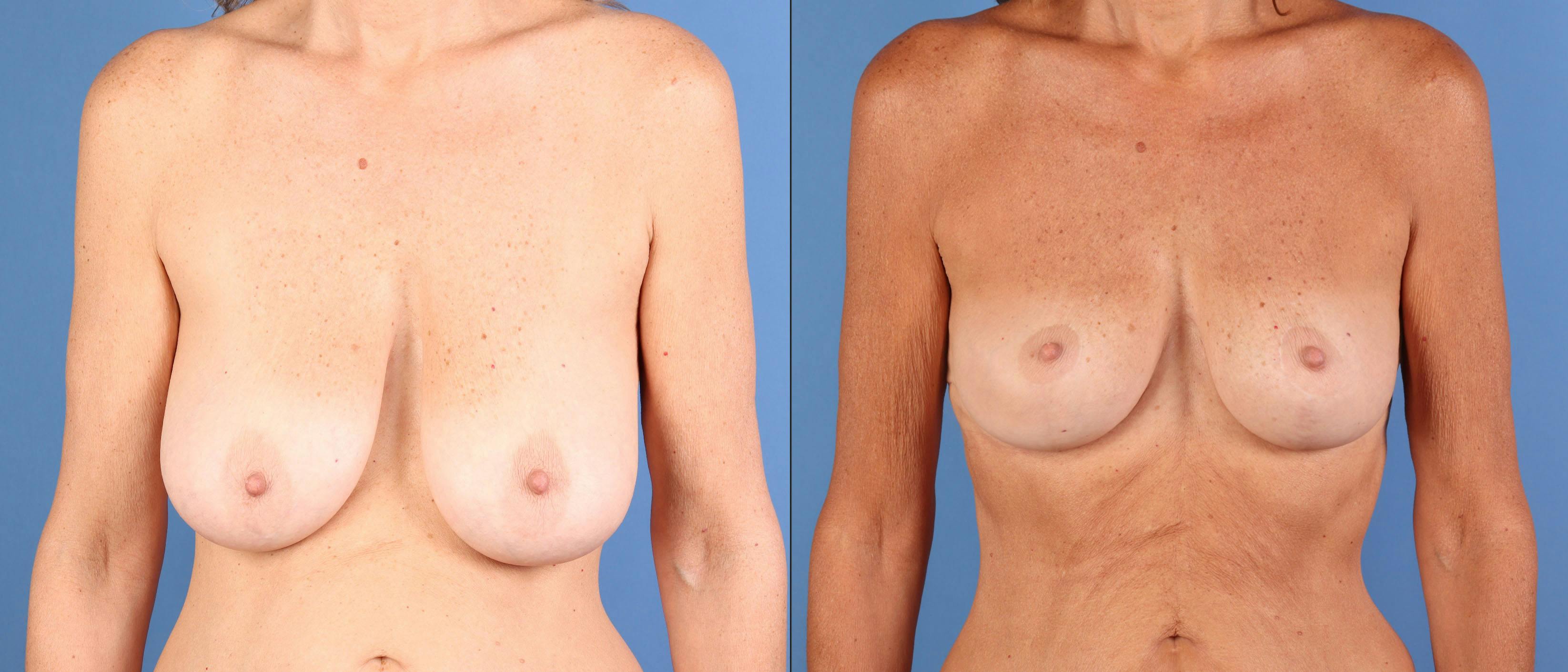 Breast Lift Before & After Gallery - Patient 110132 - Image 1