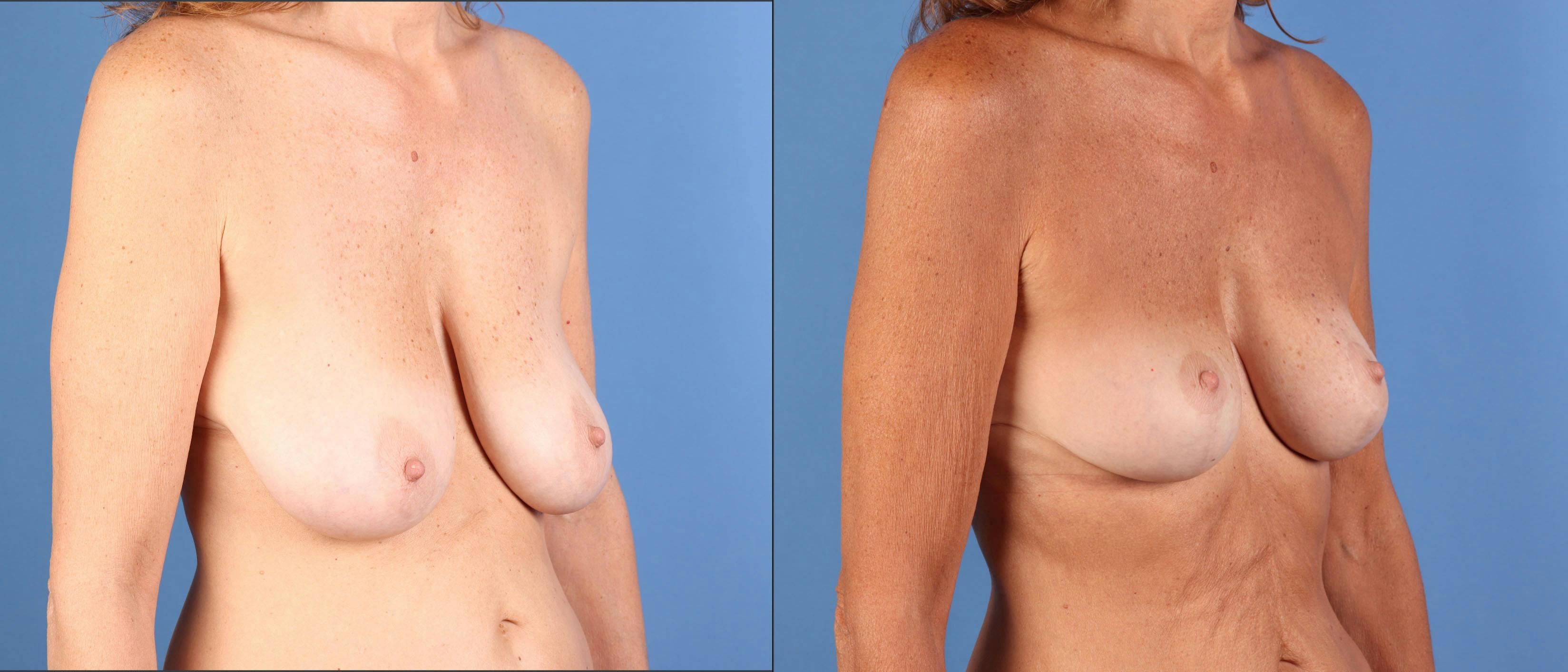 Breast Lift Before & After Gallery - Patient 110132 - Image 2
