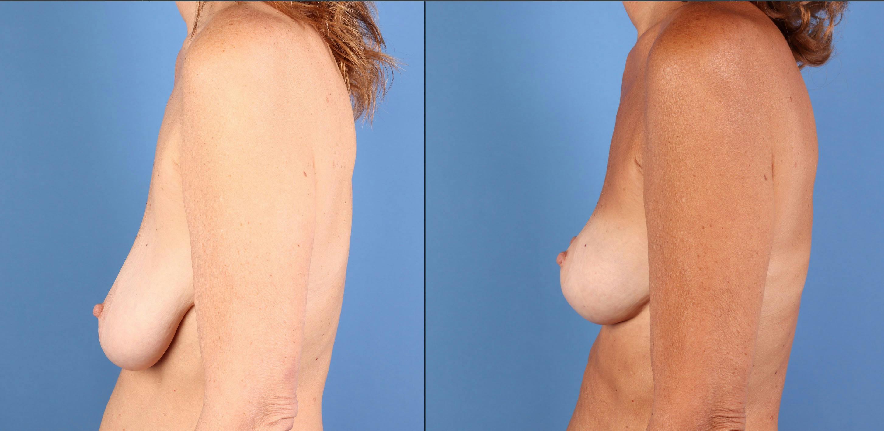 Breast Lift Before & After Gallery - Patient 110132 - Image 5