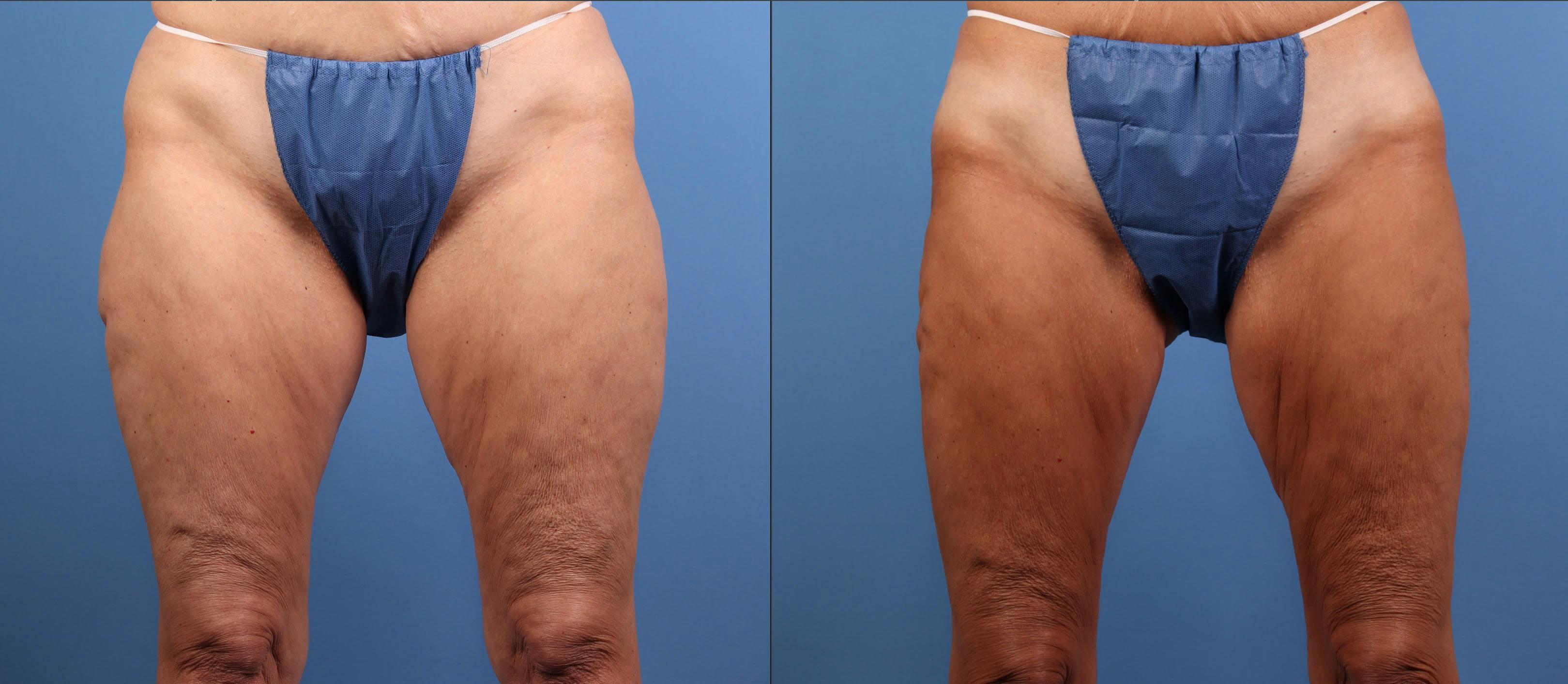 Thighs Before & After Gallery - Patient 189279 - Image 1