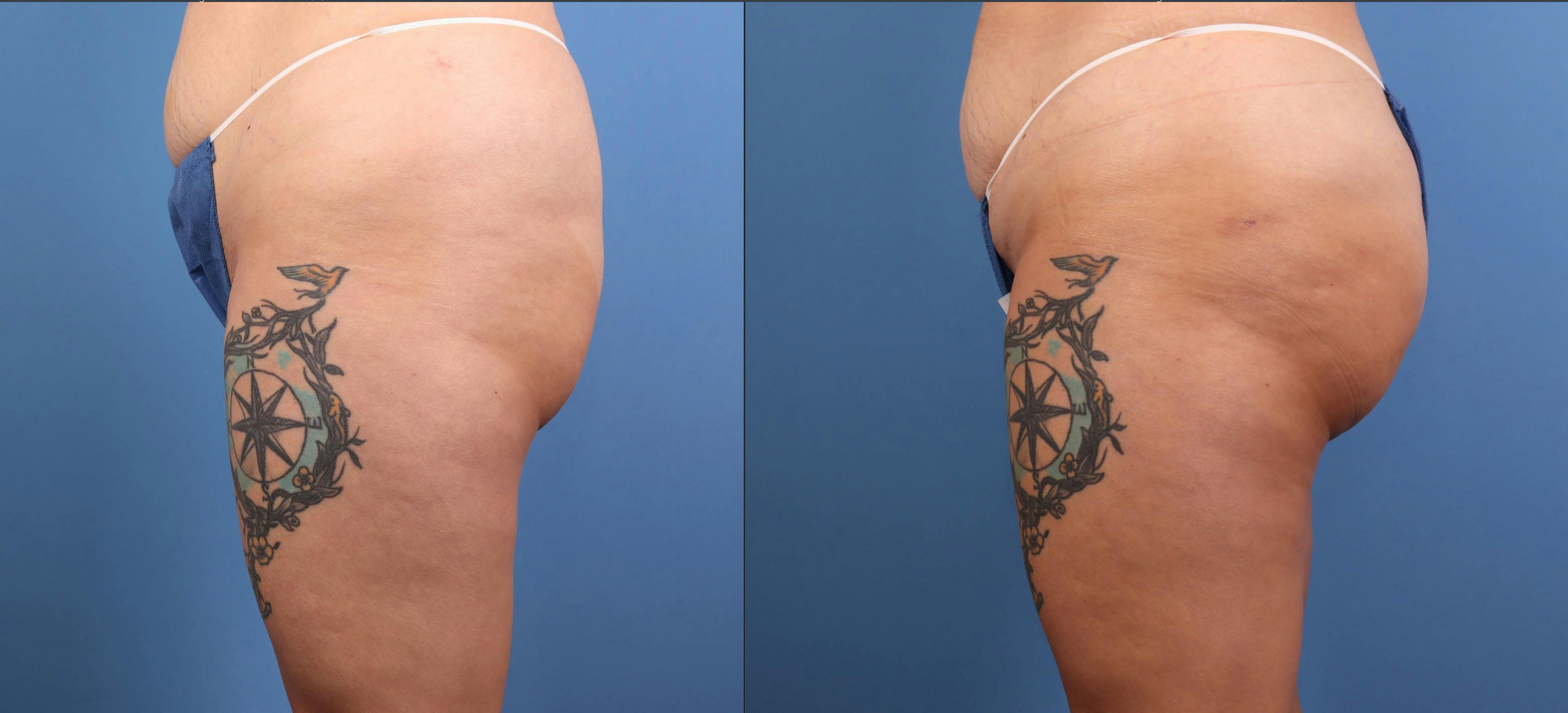 Brazilian Buttock Lift Before & After Gallery - Patient 158166 - Image 5