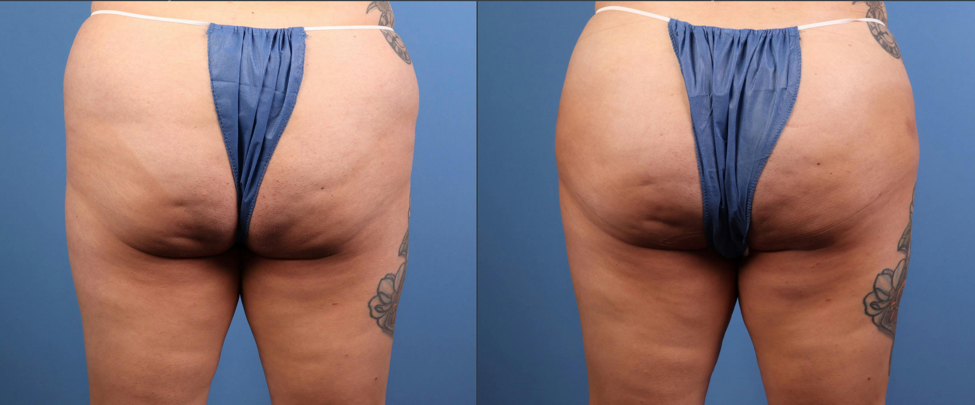 Brazilian Buttock Lift Before & After Gallery - Patient 158166 - Image 1