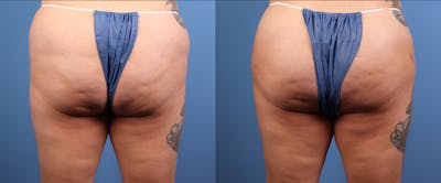 Brazilian Buttock Lift Before & After Gallery - Patient 158166 - Image 1