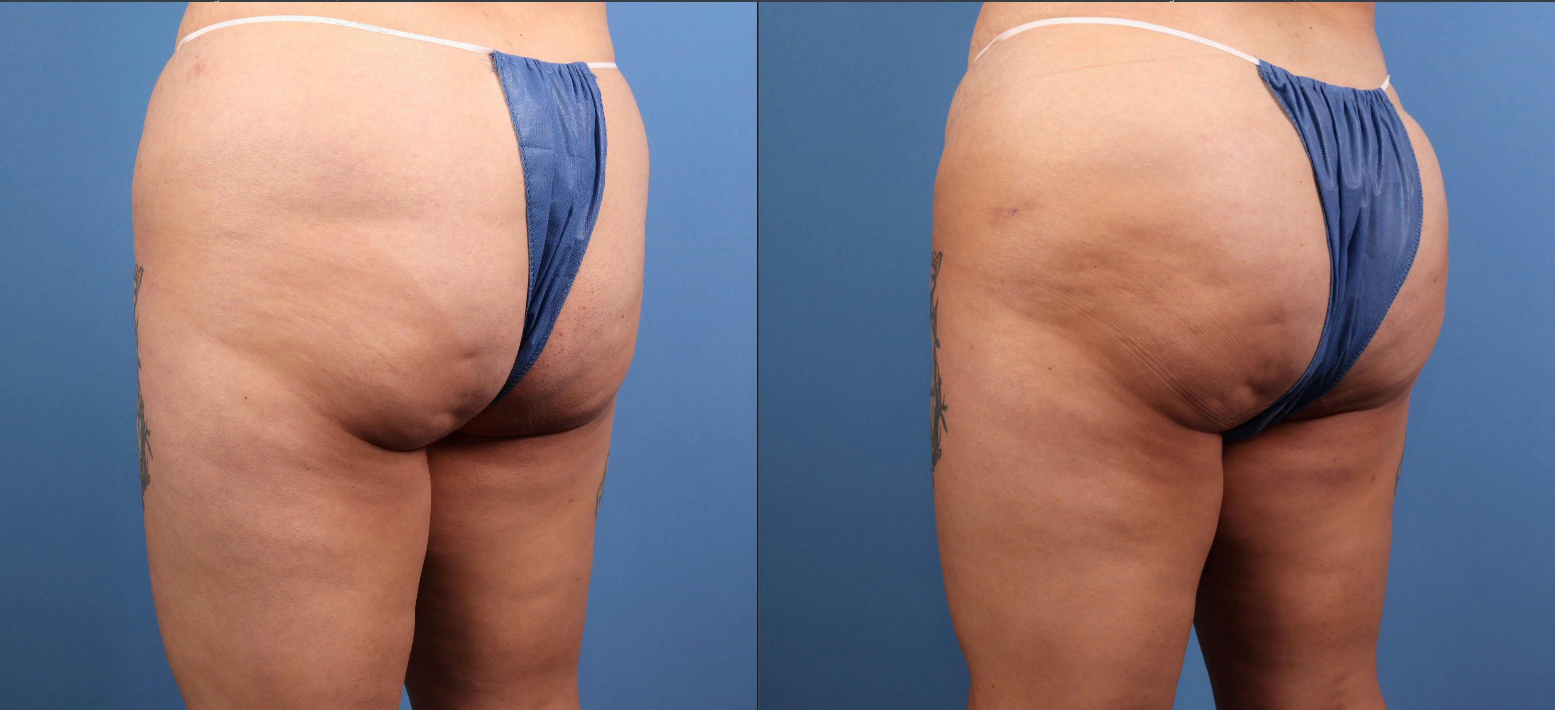 Brazilian Buttock Lift Before & After Gallery - Patient 158166 - Image 4
