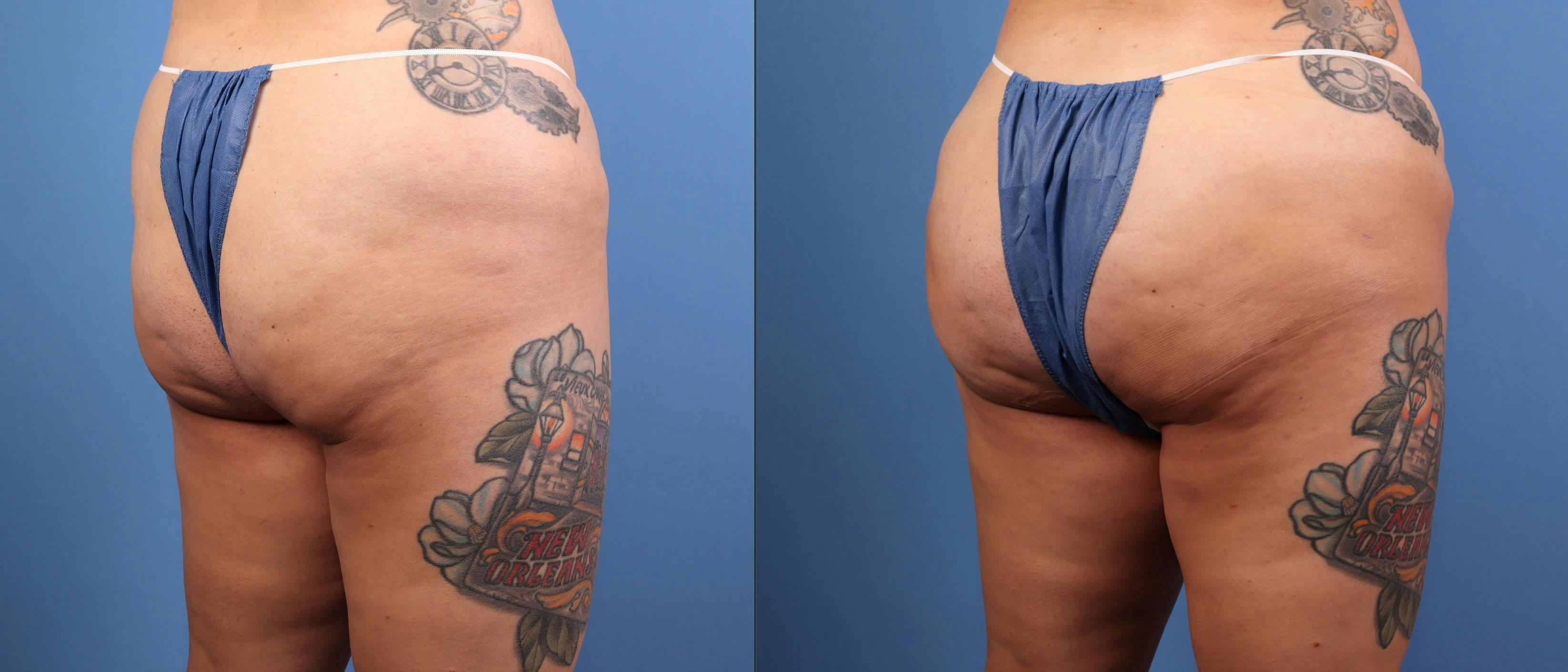 Brazilian Buttock Lift Before & After Gallery - Patient 158166 - Image 2