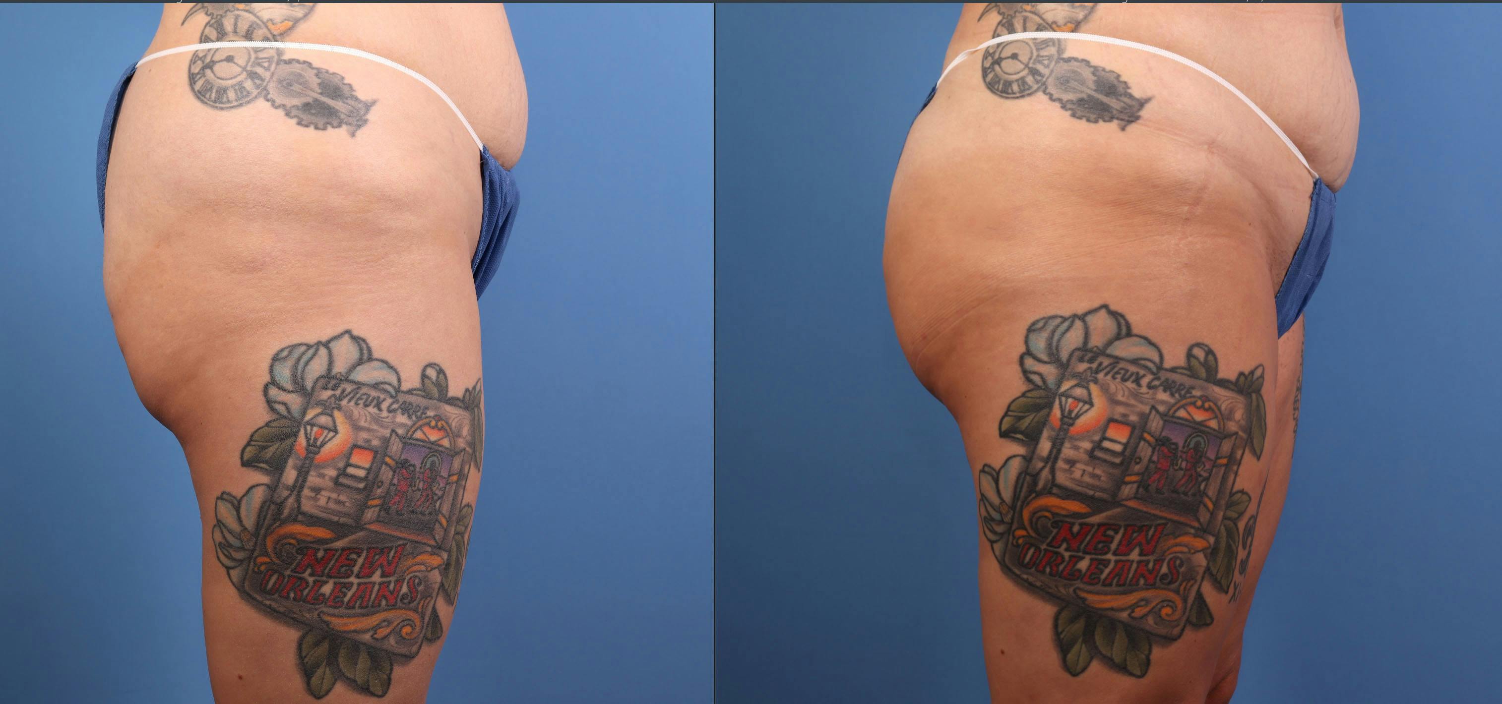 Brazilian Buttock Lift Before & After Gallery - Patient 158166 - Image 3
