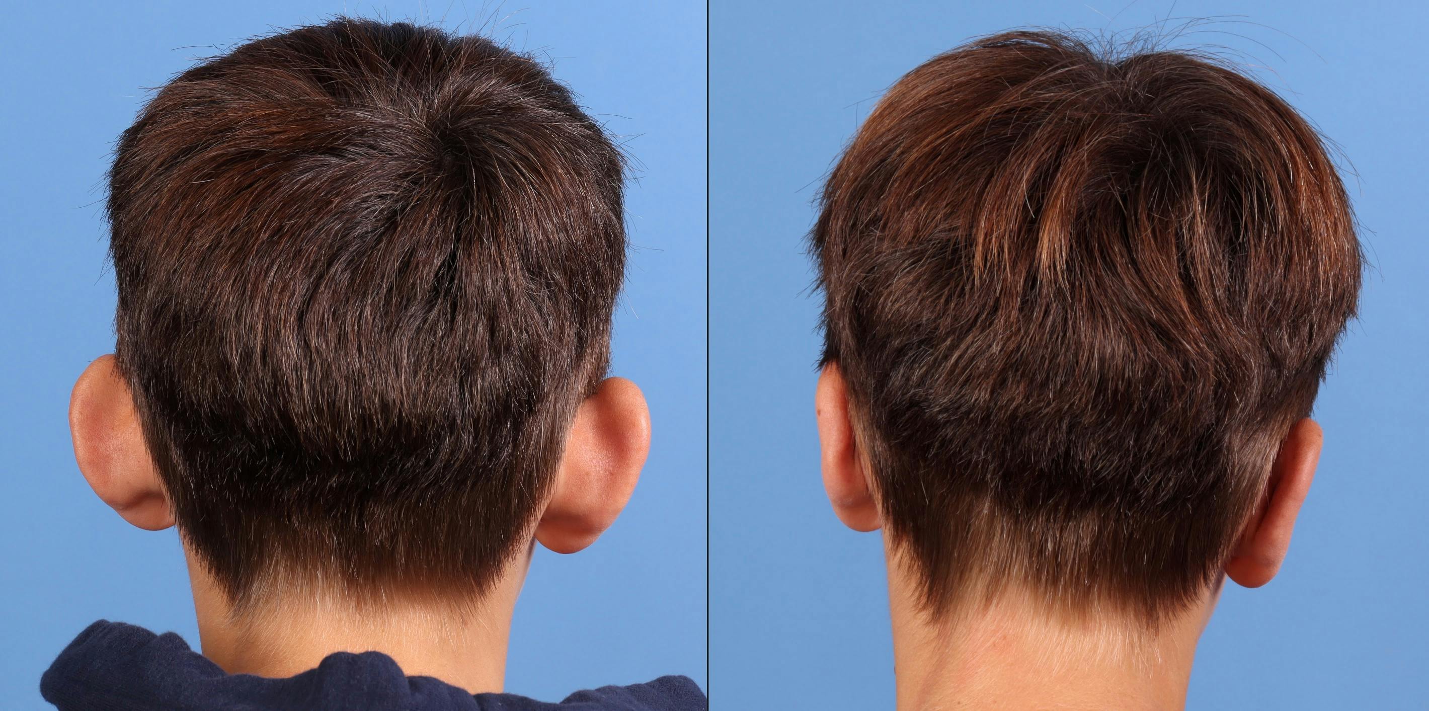 Otoplasty Before & After Gallery - Patient 151318 - Image 2