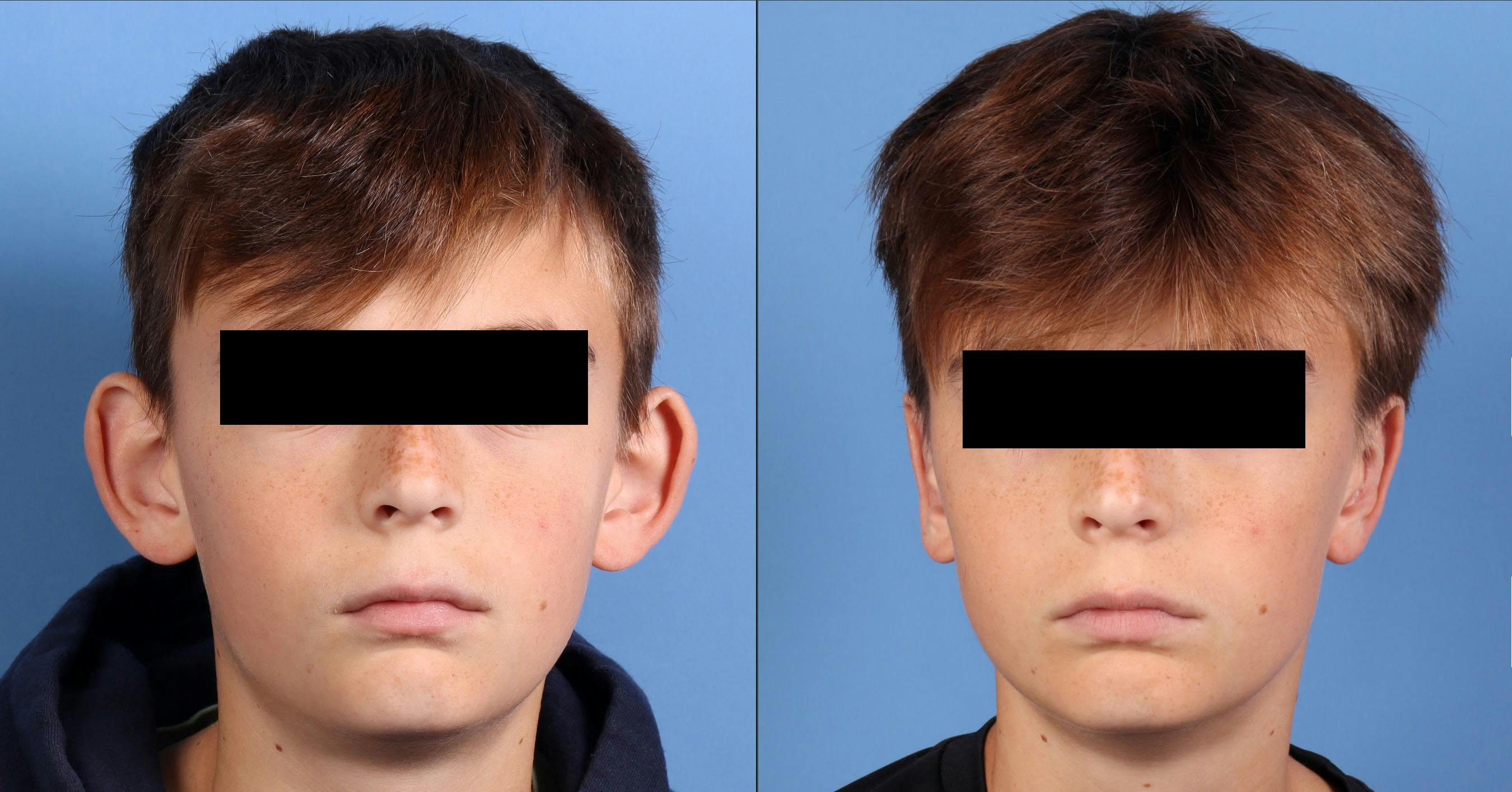 Otoplasty Before & After Gallery - Patient 151318 - Image 1