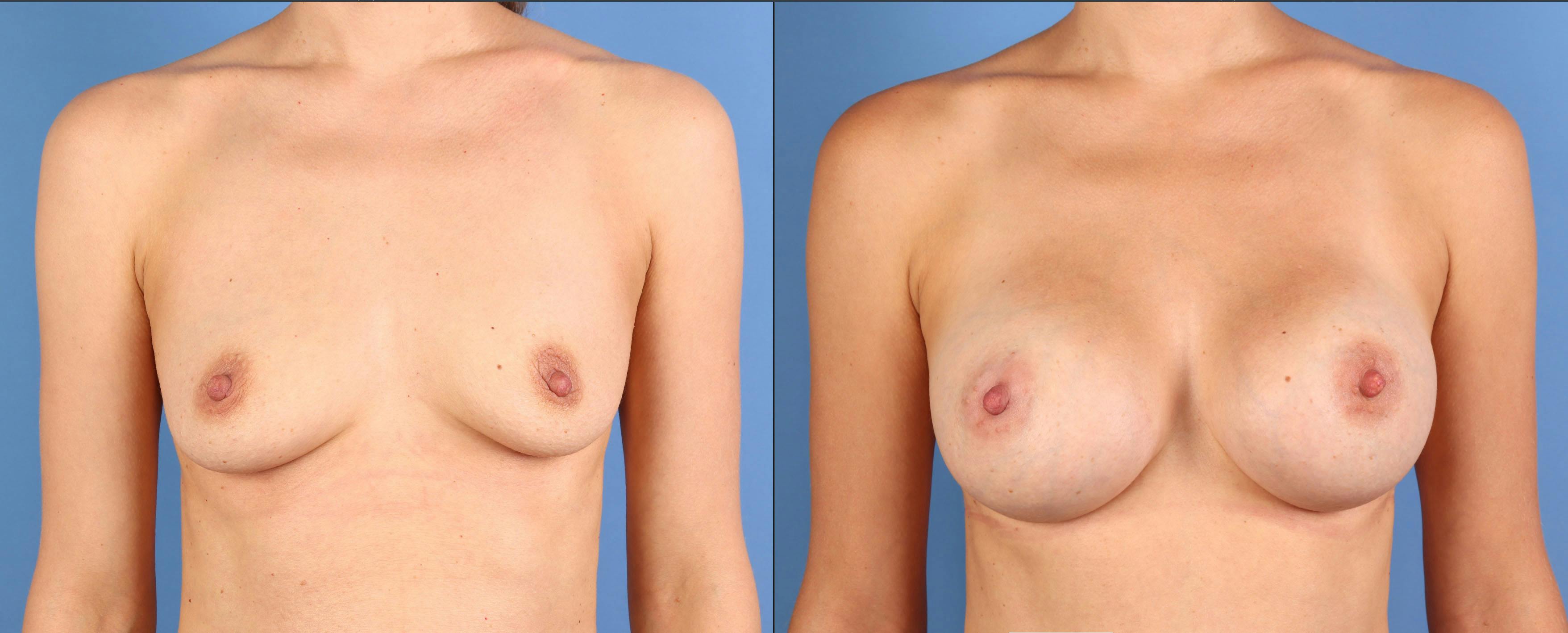 Mommy Makeover Before & After Gallery - Patient 362605 - Image 6