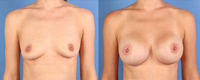 Breast Augmentation Before & After Gallery - Patient 128143 - Image 1