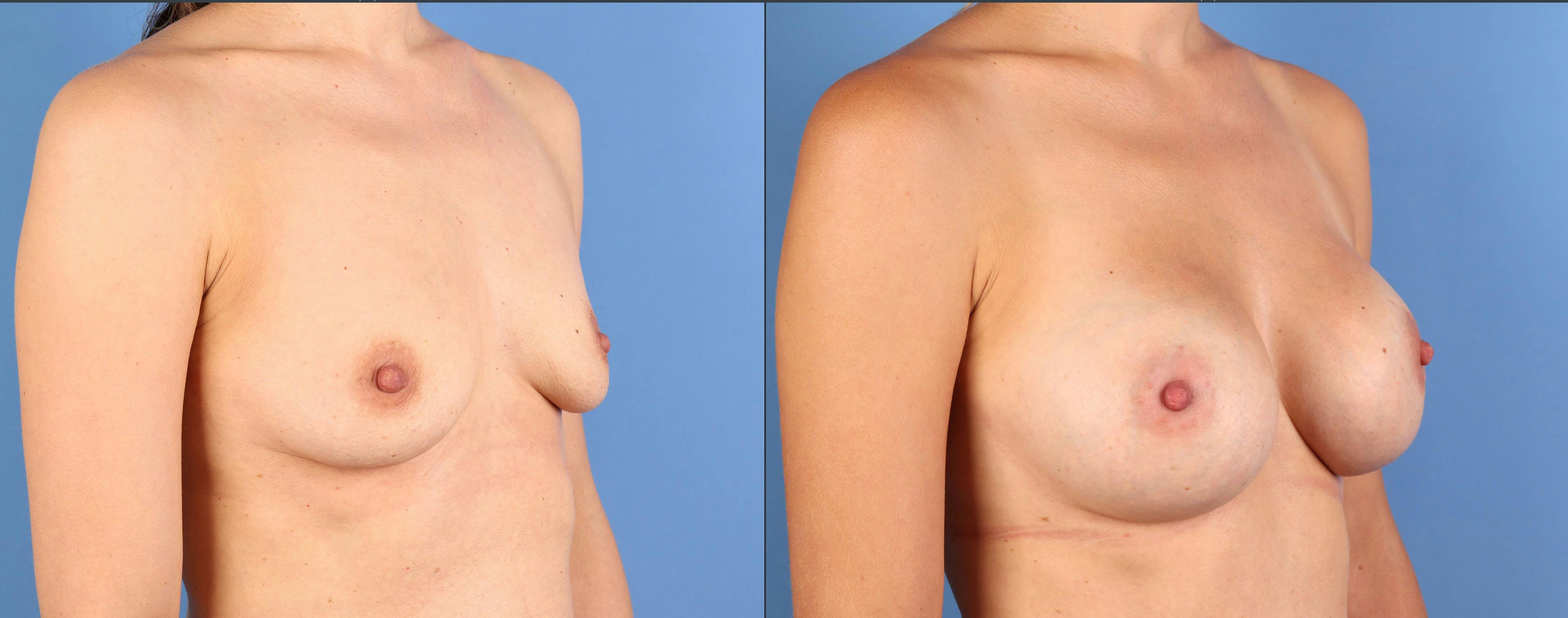 Mommy Makeover Before & After Gallery - Patient 362605 - Image 9