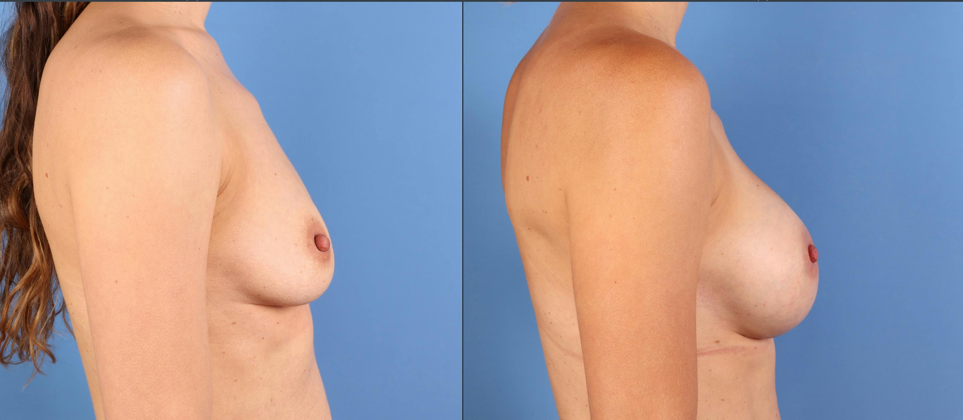 Mommy Makeover Before & After Gallery - Patient 362605 - Image 10