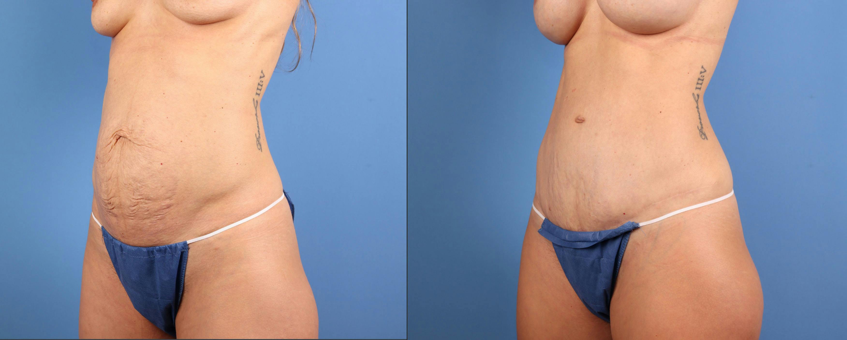 Mommy Makeover Before & After Gallery - Patient 362605 - Image 5