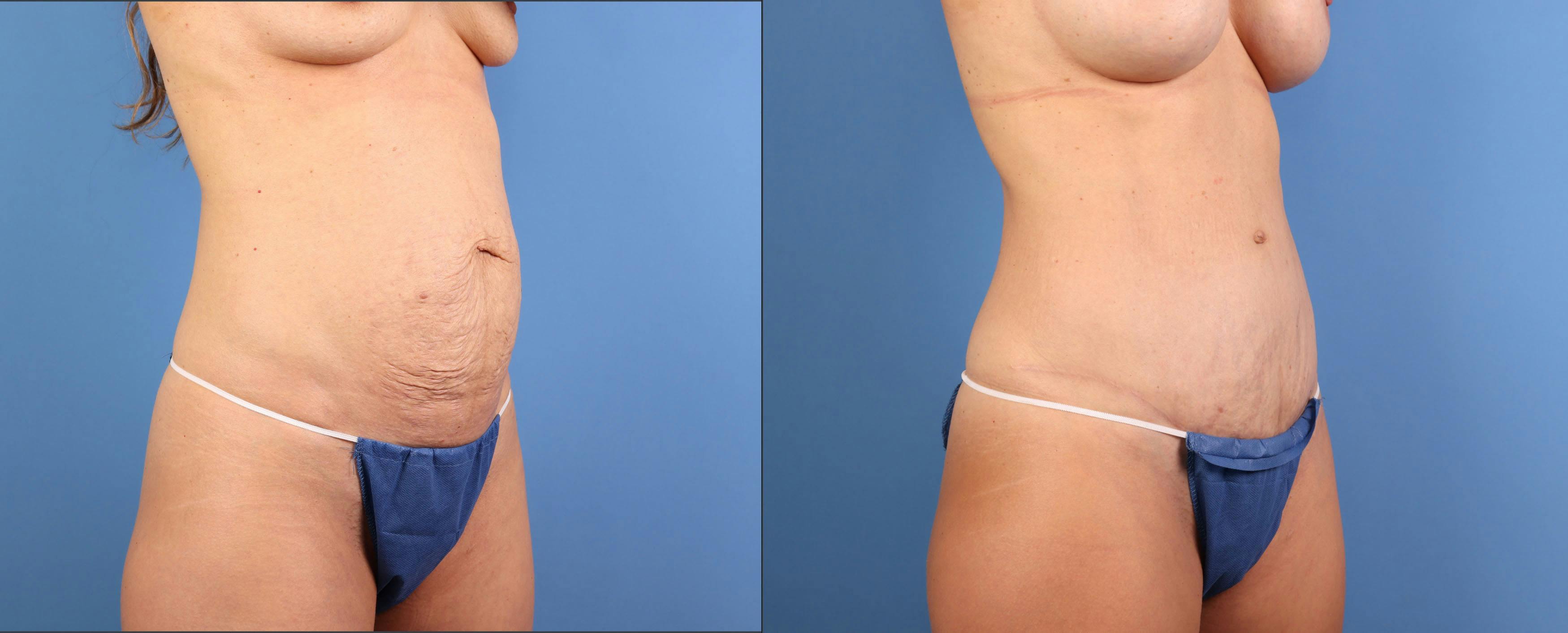 Mommy Makeover Before & After Gallery - Patient 362605 - Image 3