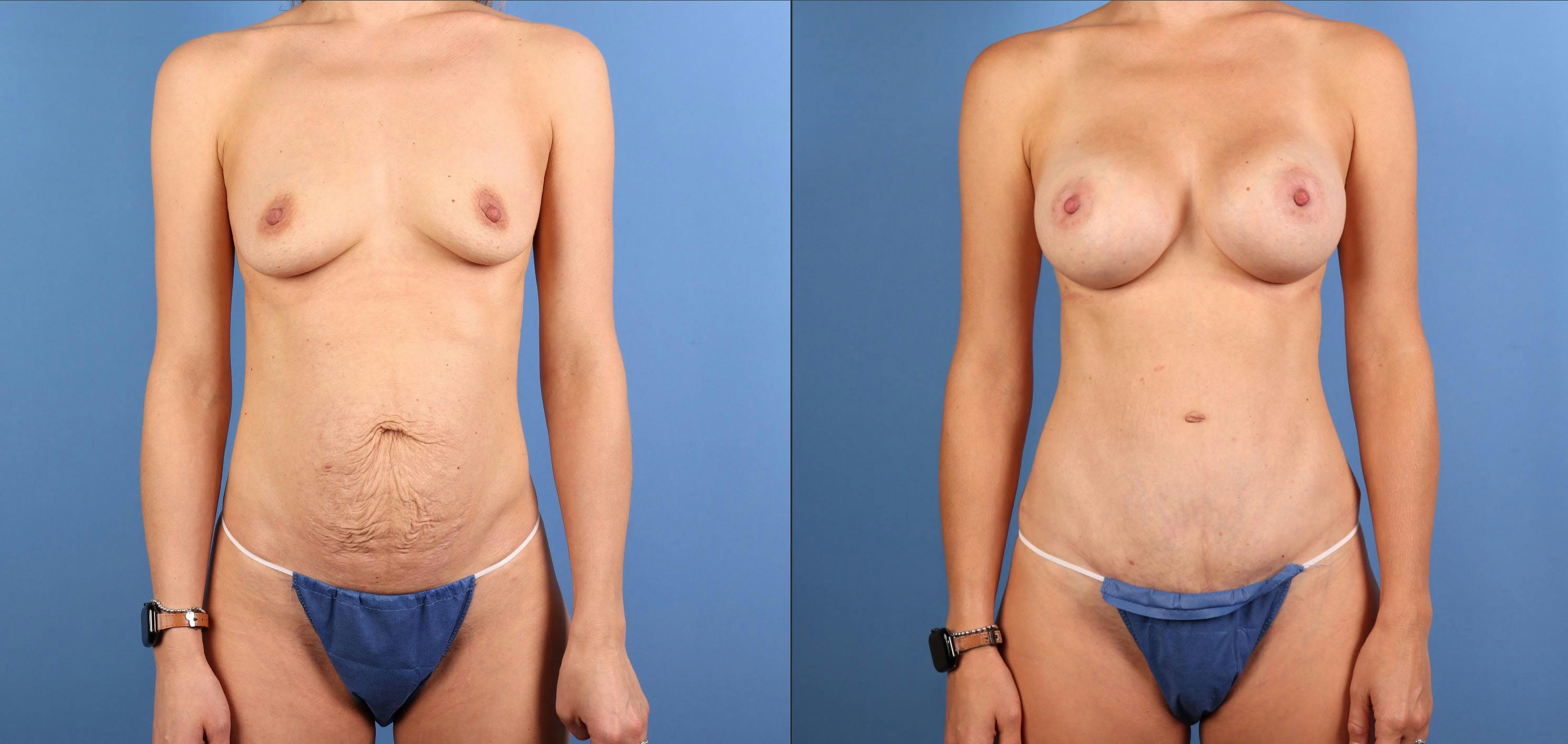 Mommy Makeover Before & After Gallery - Patient 362605 - Image 1