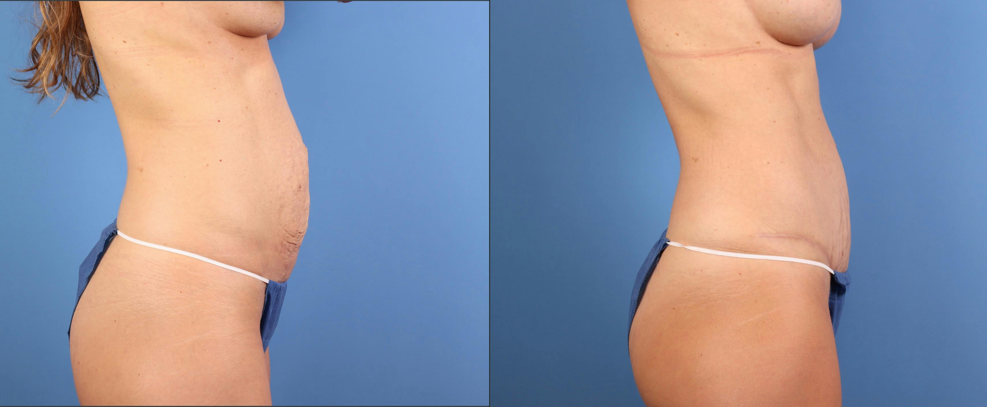 Mommy Makeover Before & After Gallery - Patient 362605 - Image 4