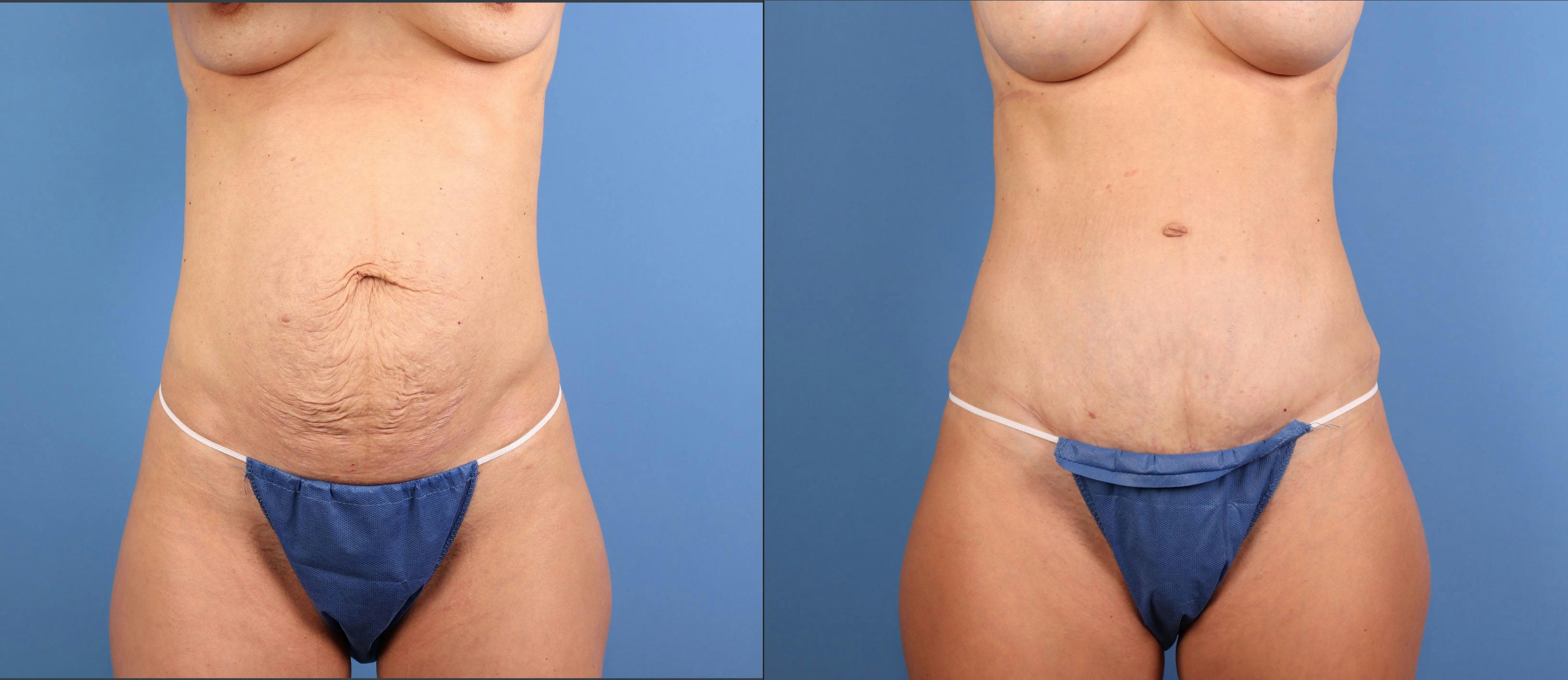 Tummy Tuck Before & After Gallery - Patient 412356 - Image 1