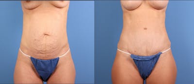 Tummy Tuck Before & After Gallery - Patient 412356 - Image 1