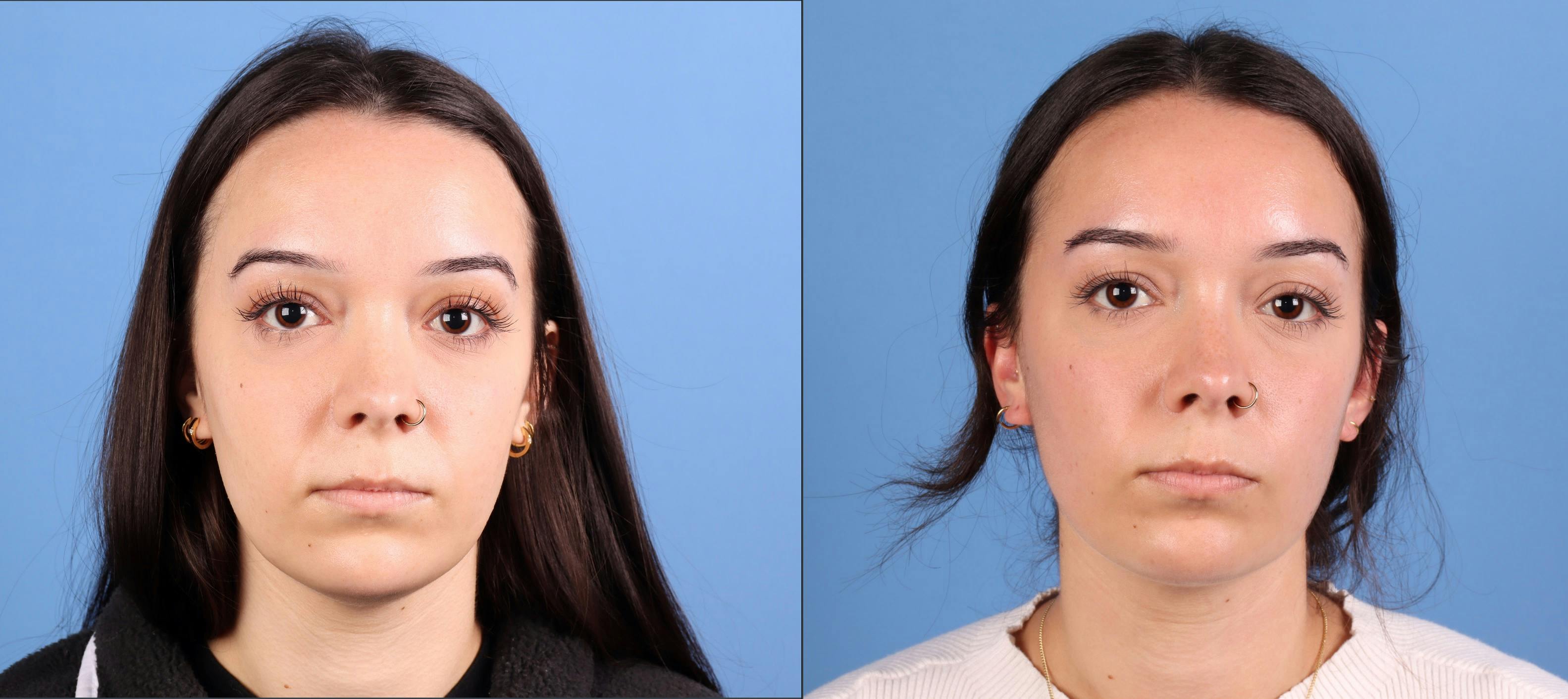 Neck and Face Liposuction Before & After Gallery - Patient 142467 - Image 1
