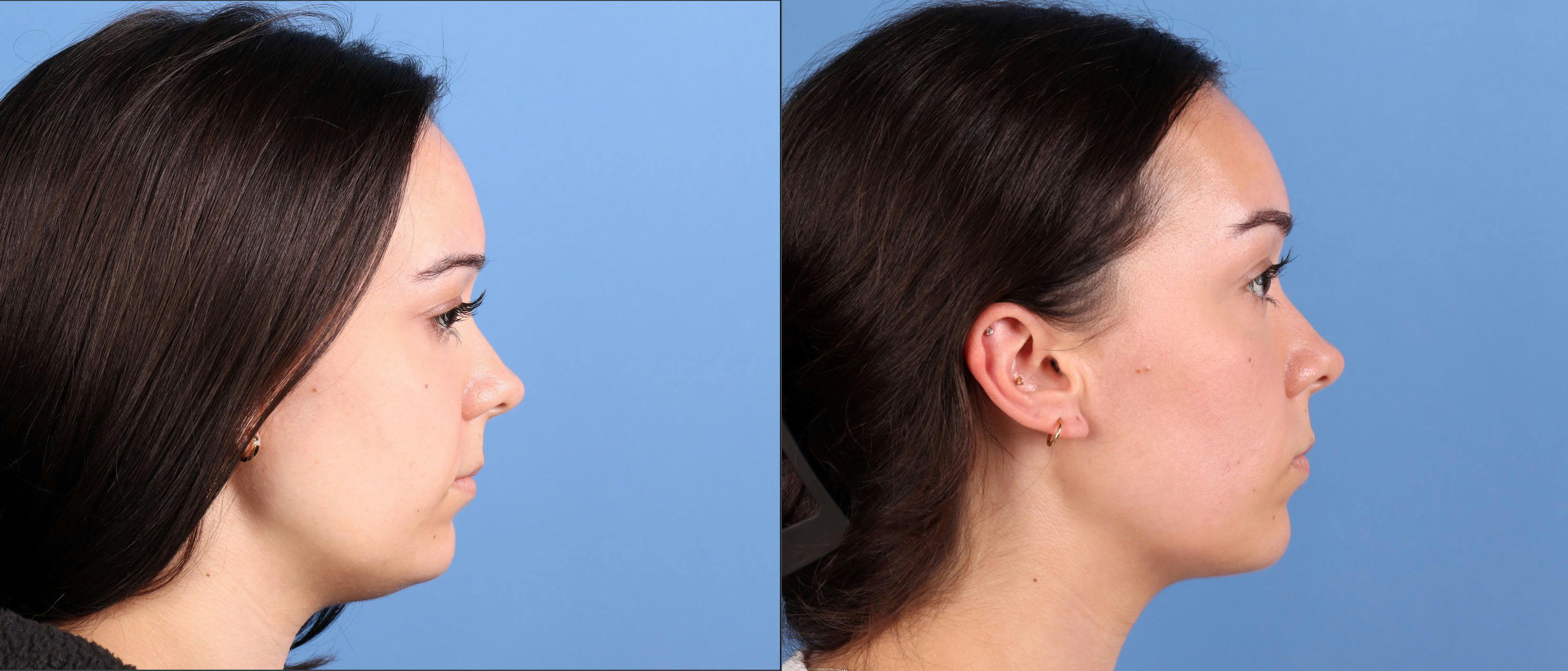 Neck and Face Liposuction Before & After Gallery - Patient 142467 - Image 5