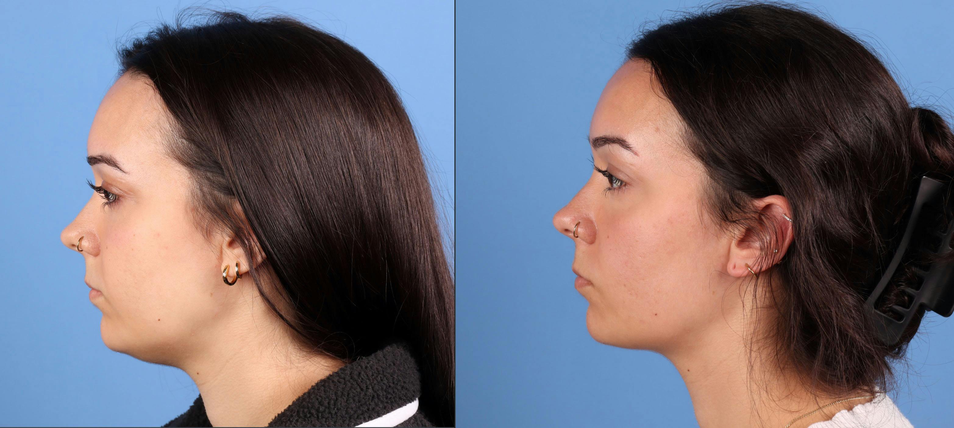 Neck and Face Liposuction Before & After Gallery - Patient 142467 - Image 3