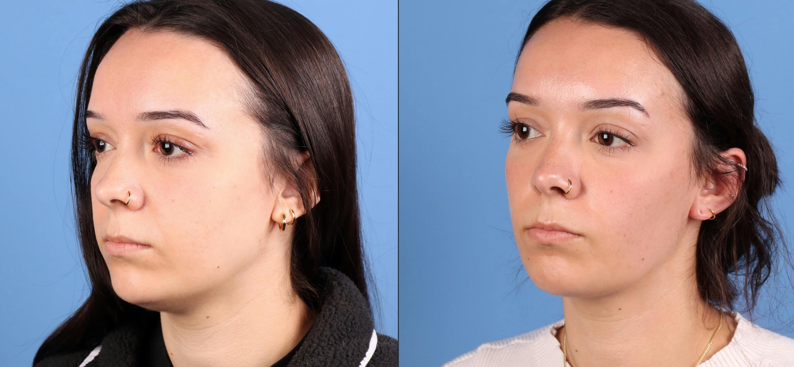 Neck and Face Liposuction Before & After Gallery - Patient 142467 - Image 2
