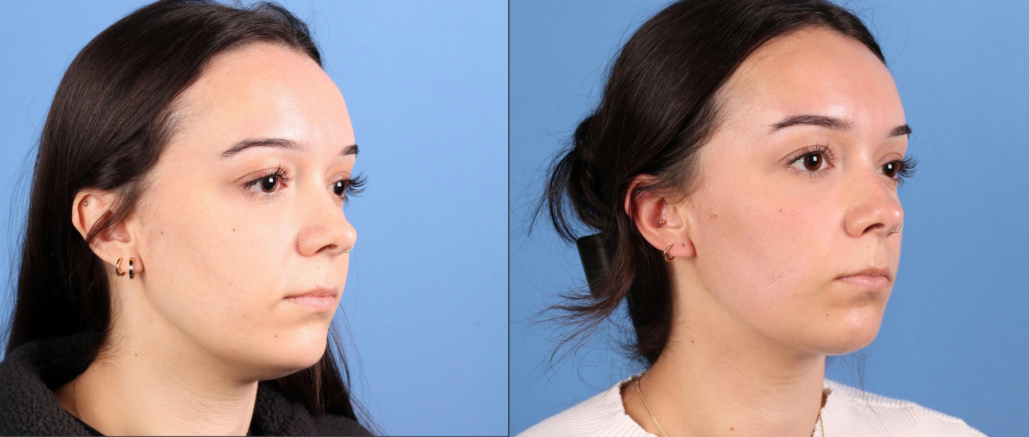 Neck and Face Liposuction Before & After Gallery - Patient 142467 - Image 4